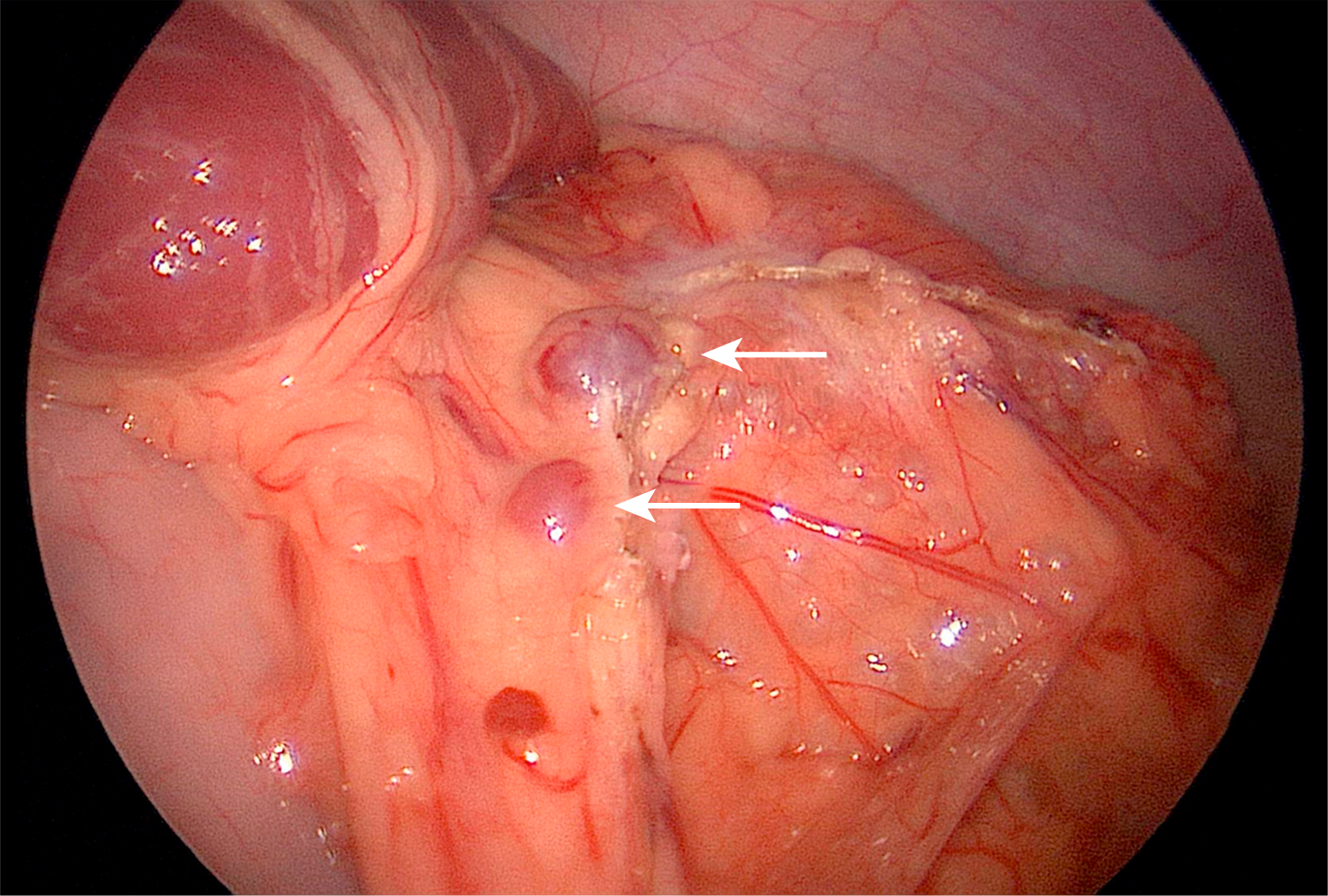 A laparoscopic view shows two small lumps, marked by arrows, at the bottom right of the rounded spleen.