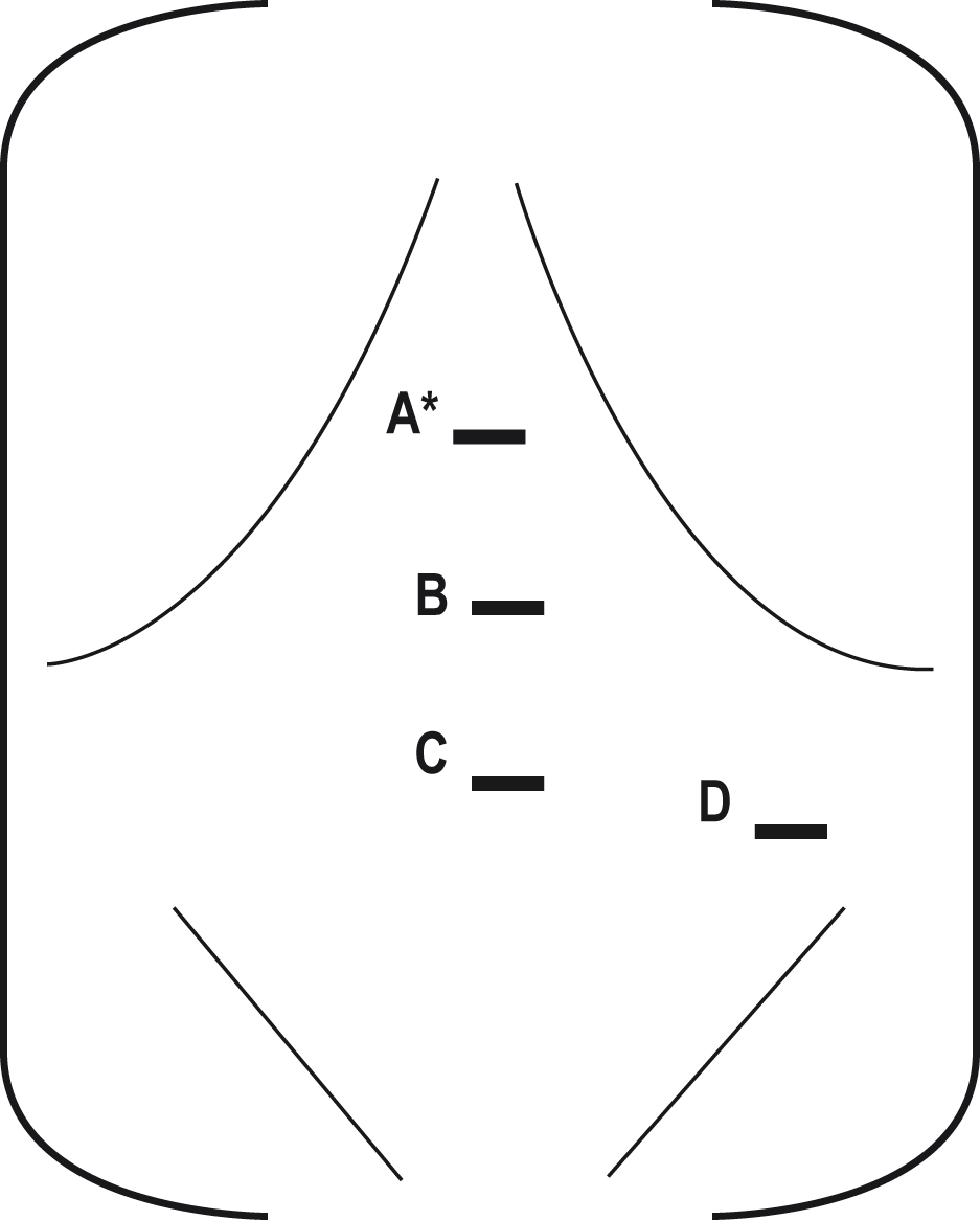 A schematic representation shows the abdominal surface with four horizontal lines marked as A, B, C, and D along the midline, denoting the port placement for a laparoscopic splenectomy. The schematic representation shows the anterior abdominal surface with four horizontal lines marked as A, B, C, and D arranged along the vertical midline. The outline represents the torso and includes the lower rib contours. The line labelled A is the most superior and is positioned near the upper abdominal region. The lines labelled B and C are placed at sequentially lower positions, with D being the most inferior, placed to the bottom right of C.