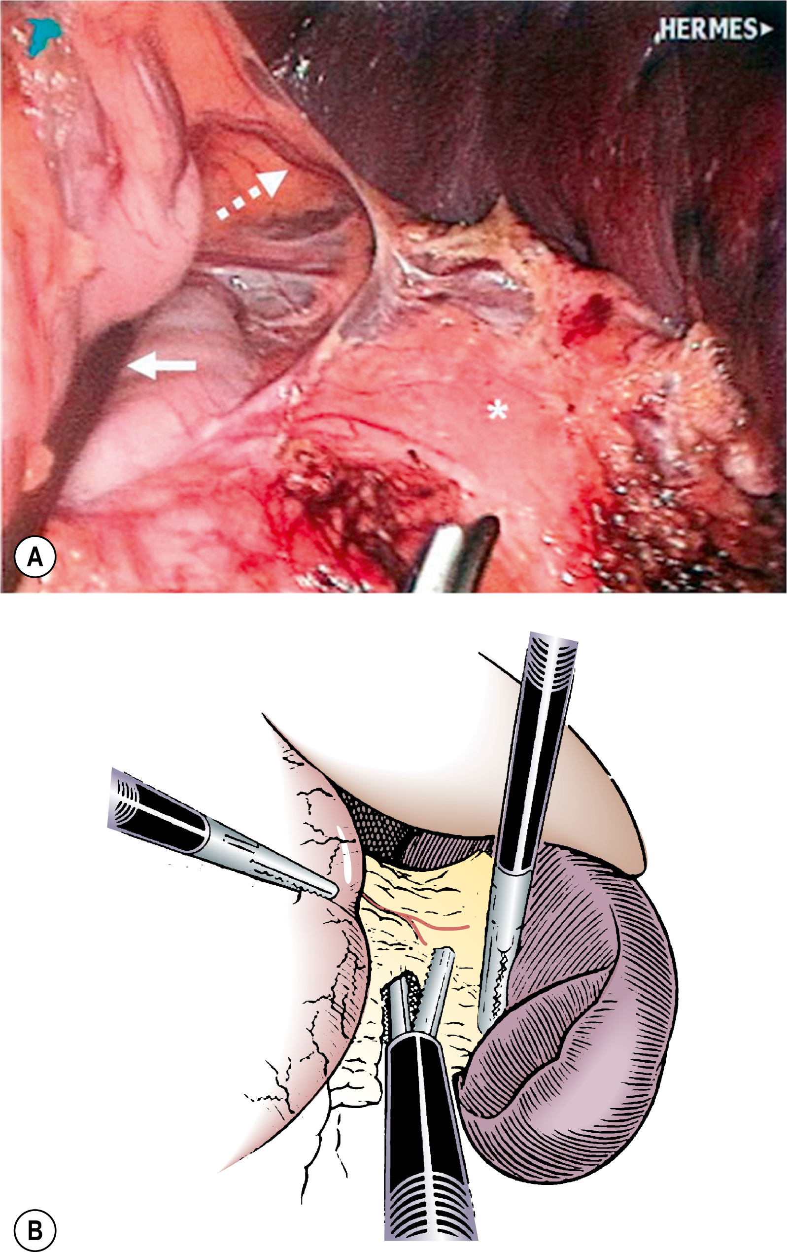 A two-part illustration shows a laparoscopic view and a schematic representation showing dissection in the abdomen for a laparoscopic splenectomy procedure. The two-part illustration displaying a laparoscopic view and a schematic representation, labeled A and B, shows dissection in the abdomen. The laparoscopic image, labeled A, displays the lower abdominal cavity with tissue layers exposed and surgical instruments inserted through trocar ports. The dissection is focused on the gastric vessels near the pancreas. The schematic view, labeled B, shows the stomach, pancreas, and the gastric vessels. Three instruments are shown entering through the anterior abdominal wall.