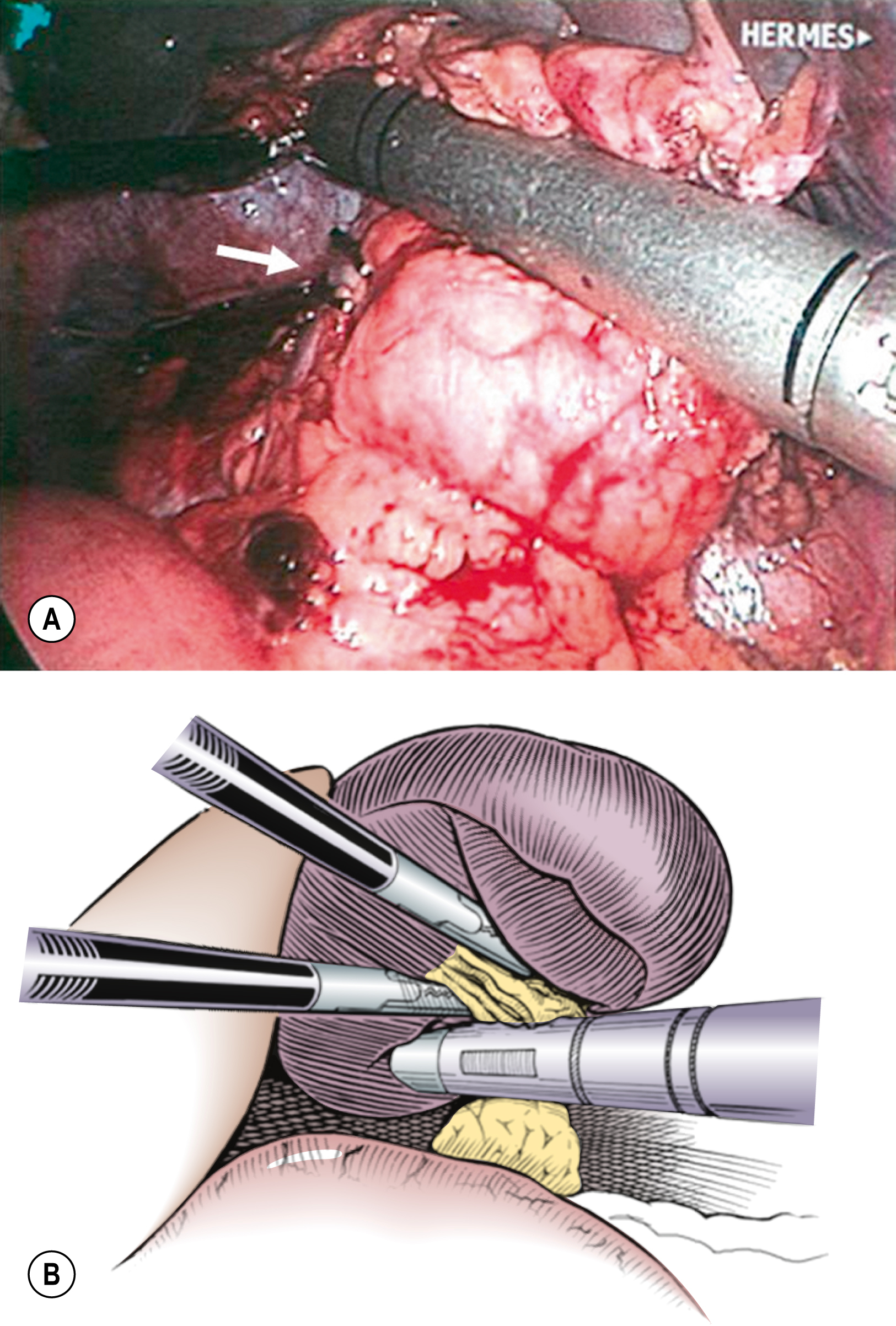 A two-part illustration shows a laparoscopic view and a schematic representation showing the final steps of a laparoscopic splenectomy procedure. The two-part illustration depicting a laparoscopic view and corresponding schematic representation, labeled A and B, shows a focused laparoscopic procedure on removing the spleen. The laparoscopic image, labeled A, captures a segment of the spleen with a large blunt instrument retracting the tissue. The surrounding soft tissue and fat are separated to reveal the contents. The schematic below, labeled B, shows a cross-section of the lower abdominal wall with three surgical instruments inserted through ports and one of them positioned below the spleen.