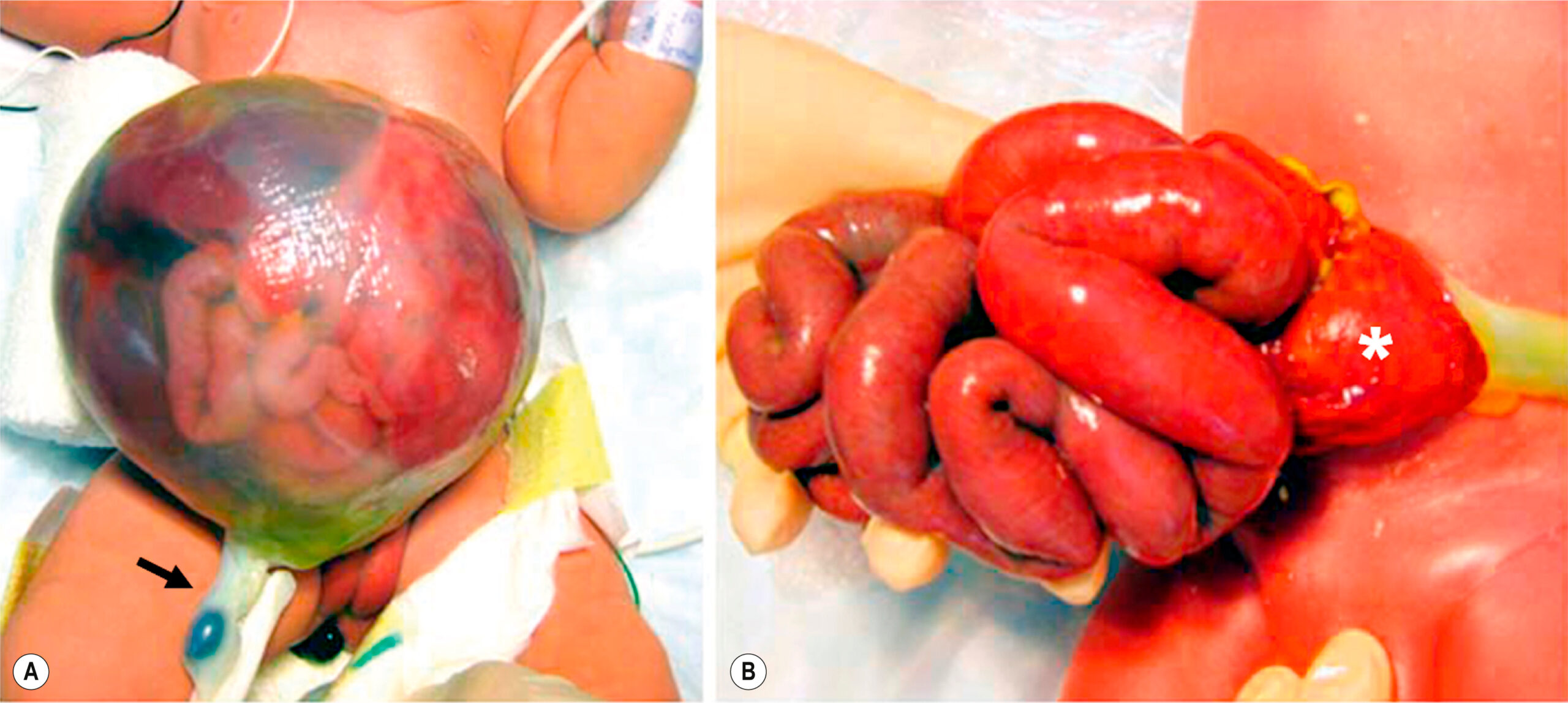 Two clinical views show a newborn with abdominal contents herniated into a sac and exteriorized bowel loops after sac removal. The two clinical views, labeled A and B, show a newborn with abdominal contents herniated outside the body through a defect in the abdominal wall. Panel A shows a translucent sac containing loops of bowel protruding from the central abdomen of a newborn. The sac is intact, rounded, and smooth, enclosing multiple visible intestinal loops. The umbilical cord is present near the lower abdomen. Panel B shows a newborn with exposed bowel loops externalized from the abdominal cavity. The loops are coiled and show variation in contour, and the stomach is clearly visible at the base.