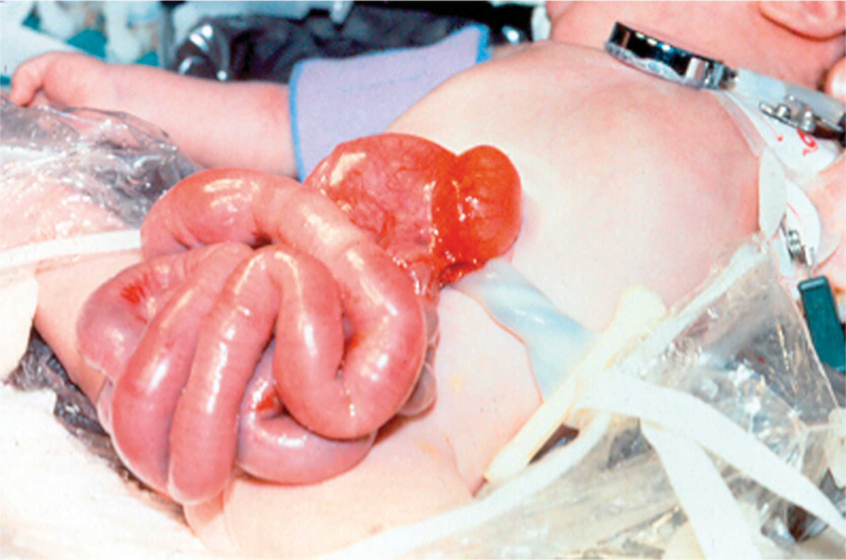 A clinical view shows a newborn with herniated bowel loops protruding through an abdominal wall defect, without a sac, and resting on the lower abdomen.