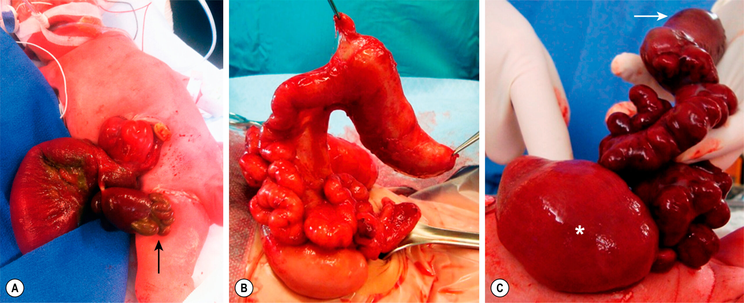Three clinical views show stages of neonatal abdominal surgery with bowel segments, liver, and abnormal intestinal loops exposed. The three clinical views, labeled A, B, and C, show progressive stages of neonatal abdominal surgery involving abnormal bowel development. Panel A shows herniated bowel segments of varying contour emerging from an abdominal defect. A segment of bowel appears distended, and an arrow points to a loop with abnormal texture. Panel B displays further exposure of the abdominal contents with a prominent jejunum suspended and surrounded by smaller loops. The tissue shows irregular folding and tapering. Panel C shows the intestine and colon being held by gloved hands. An asterisk marks a large stomach.