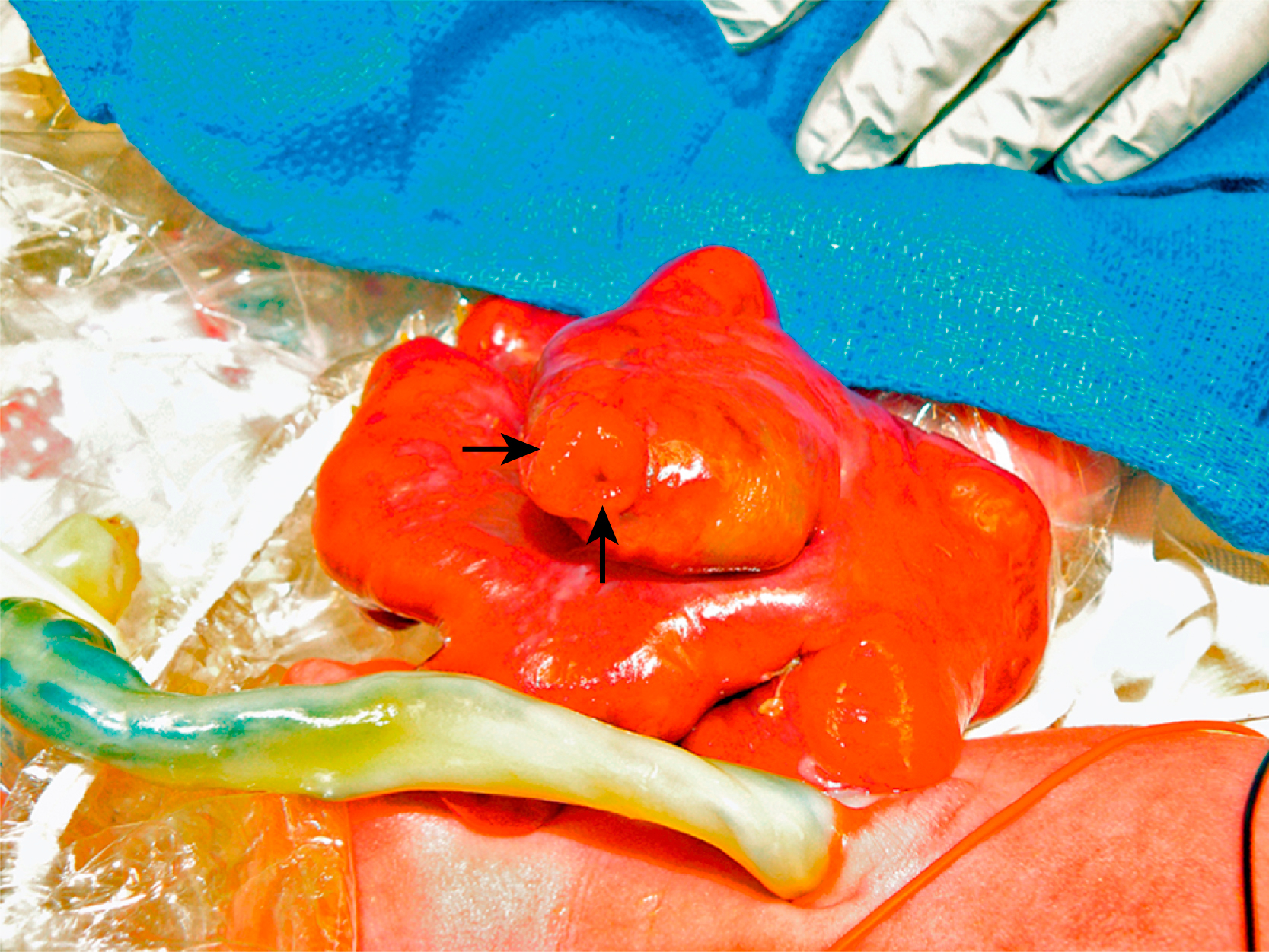 A clinical view shows a newborn bowel segment with a central, rounded outpouching, with two cavities marked by arrows, and a nearby umbilical cord on a surgical surface.