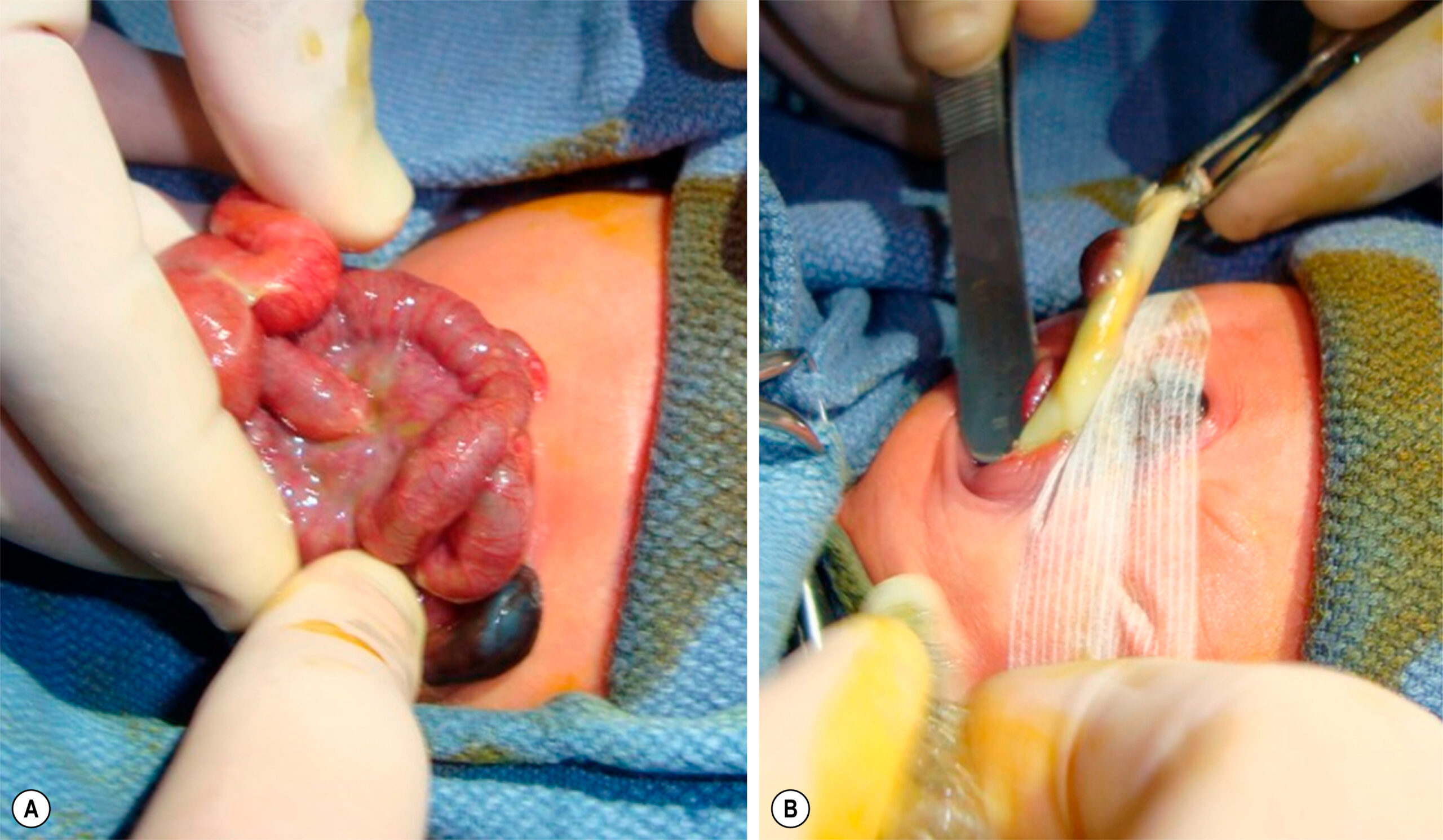 Two clinical views show a neonatal abdominal wall defect with herniated bowel and subsequent coverage using a sterile dressing. The two clinical views, labeled A and B, show the management of an abdominal wall defect in a newborn. Panel A shows herniated loops of bowel emerging through a central abdominal defect, held in place by gloved hands. The bowel is coiled and protrudes without a covering sac. A small amount of dark meconium is visible at the base. Panel B shows the next step, where the bowel is being pushed along with umbilical cord into the umbilicus and wrapped using a sterile dressing material held in position with surgical instruments.