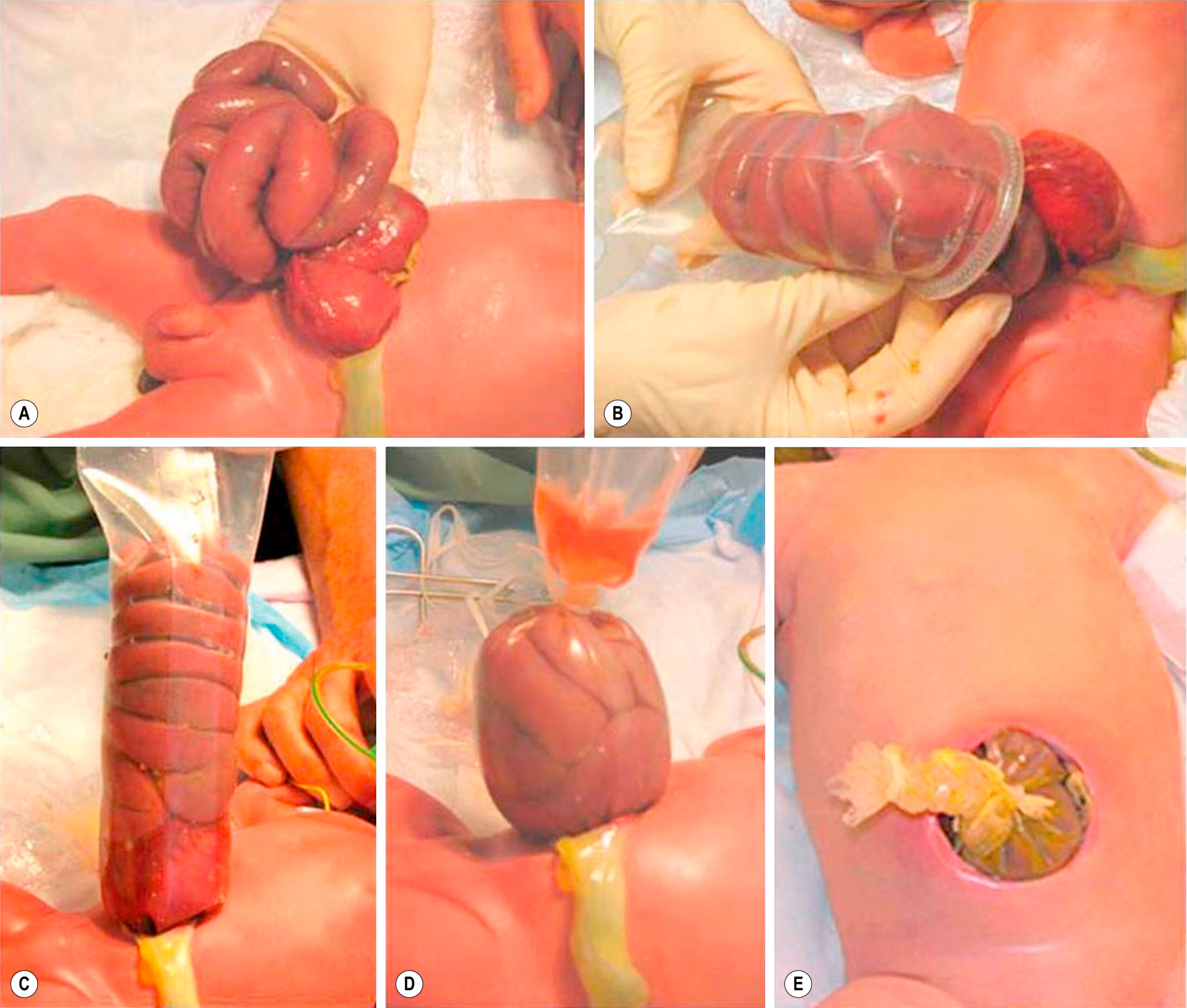 Five clinical views show sequential steps in the staged reduction of herniated bowel loops using a silo in a newborn. The five clinical views, labeled A to E, show sequential steps in the staged reduction of herniated bowel loops in a newborn using a silo. Panel A shows loops of bowel protruding from an abdominal wall defect, resting on the surface. Panel B shows placement of the bowel into a transparent tubular silo that is being positioned over the abdominal defect. Panel C shows the bowel completely enclosed within the silo, which is secured at the abdominal opening. Panel D shows gradual downward reduction of the bowel into the abdominal cavity by gravitational assistance. Panel E shows the final stage, with the bowel reduced and only a small segment of intestine visible within the closed dressing.