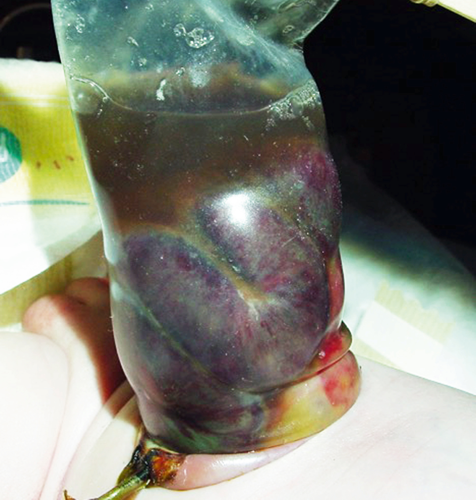 A clinical view shows herniated bowel loops enclosed in a transparent silo placed over an abdominal wall defect in a newborn. The clinical view shows a newborn with herniated bowel loops enclosed in a transparent tubular silo. The silo is positioned over an abdominal wall defect, allowing the bowel to remain suspended above the surface. The loops of bowel inside the silo are distended, necrotic, with accumulated fluid clearly visible through the transparent material.