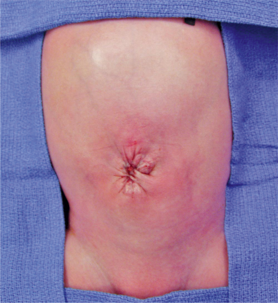 A clinical view shows a healed umbilical region with a central star-shaped scar, in a newborn after abdominal wall defect repair.