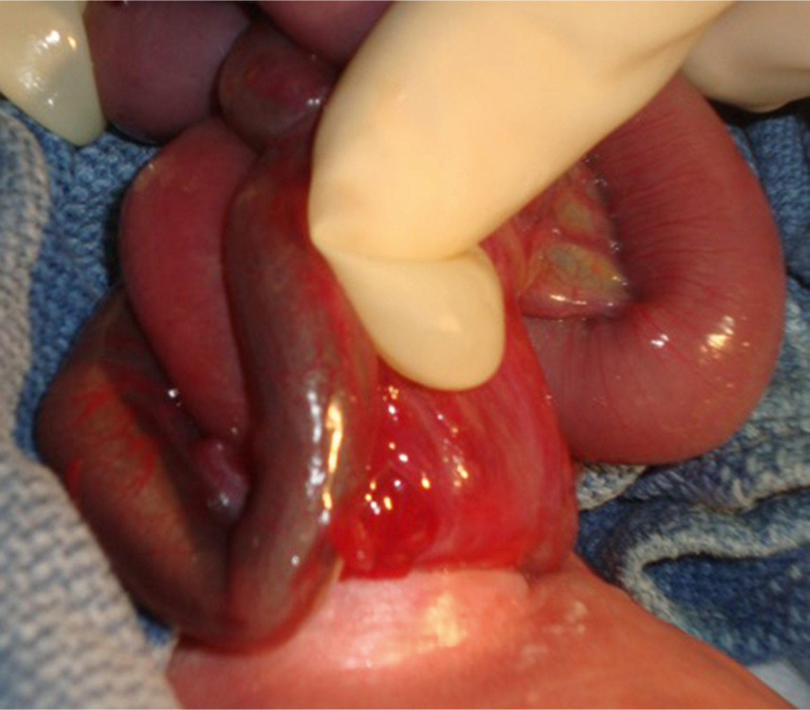 A clinical view shows a gloved hand examining herniated bowel loops in a newborn with a visible transition in bowel texture. The clinical view shows a close-up of a newborn with herniated bowel loops being examined by a gloved hand. The bowel is gently held and partially rotated to reveal different segments. There is a visible transition in texture and contour along the bowel, with one portion appearing swollen and another segment narrower and smoother. The bowel loops are arranged in overlapping coils outside the abdominal cavity.