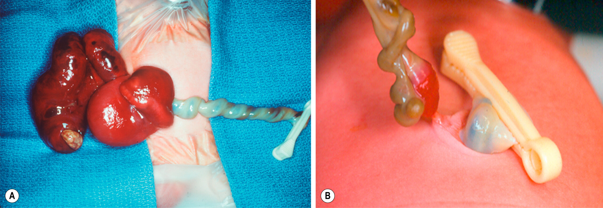 Two clinical views show newborns with bowel loops and umbilical remnants herniated through the abdominal wall. The two clinical views, labeled A and B, show newborns with bowel loops and umbilical remnants protruding through the abdominal wall. Panel A shows a newborn with multiple thickened and distended bowel loops exteriorized at the midline, adjacent to a twisted and edematous umbilical cord segment. The skin around the defect is cleanly draped, and the exposed abdominal contents rest on the surface. Panel B shows another newborn with a smaller protruding bowel loop emerging near the umbilical base. The bowel is narrow and tubular, with a portion of the umbilical cord clamped and lying adjacent to the defect.