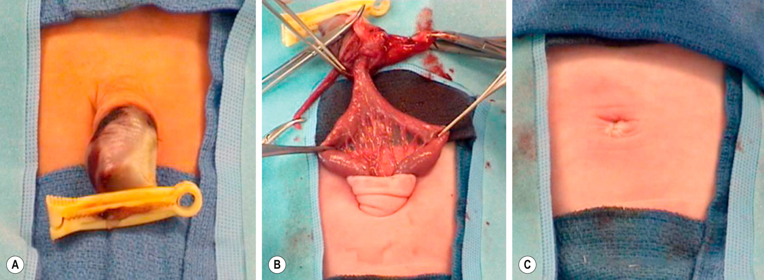 Three clinical views show stages of abdominal wall defect repair in a newborn from exposure to closure. The three clinical views, labeled A, B, and C, show the sequential stages of surgical repair for an abdominal wall defect in a newborn. Panel A shows initial exposure, with bowel loops protruding through a midline abdominal defect. Panel B shows intraoperative dissection with retracted tissue and exposed abdominal contents. Sutures and instruments are visible maintaining the surgical field. Panel C shows the final appearance following closure, with the abdominal skin approximated and a small central scar at the umbilical site.