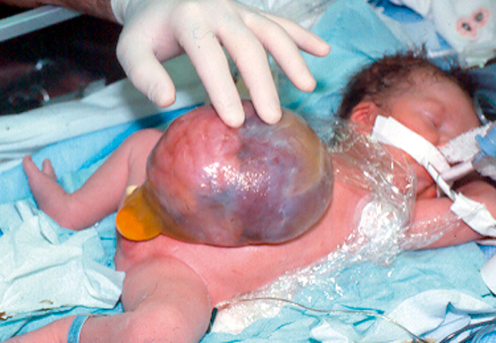 A clinical view shows a newborn with a large, rounded sac protruding from the midline abdominal region. The sac is tense and translucent, enclosing the loops of bowel.
