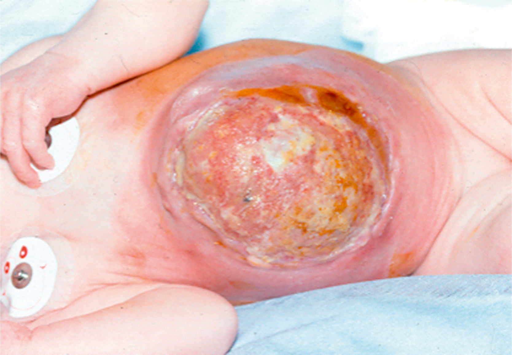 A clinical view shows a newborn with a large abdominal sac having an irregular and thickened surface with central discoloration. The clinical view shows a newborn with a large abdominal sac protruding from the central abdomen. The sac has a thickened and irregular external surface with visible variation in texture and a central area of discoloration. The surface appears structurally compromised.