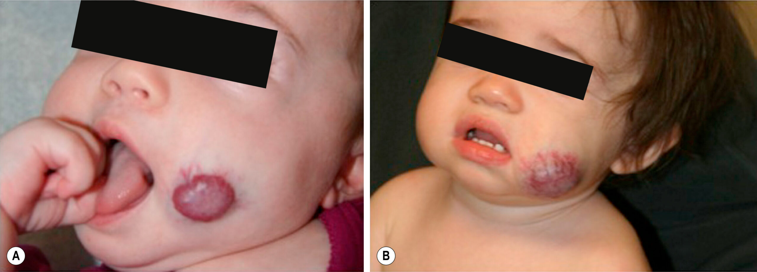 A two-part clinical photograph of infants shows dark skin lesions on the cheek. The two-part clinical photographs, labeled A and B, show two infants with vascular lesions on the cheek. Panel A shows an infant with a raised, round, dark lesion located on the lower right cheek near the mouth. Panel B shows the same infant at a different age with a slightly faded lesion on the same region of the face.