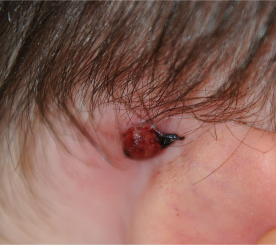 A clinical photograph shows a close-up view of a child’s face, focusing on a raised, red lesion on the face, featuring a dark crust or scab on its surface.