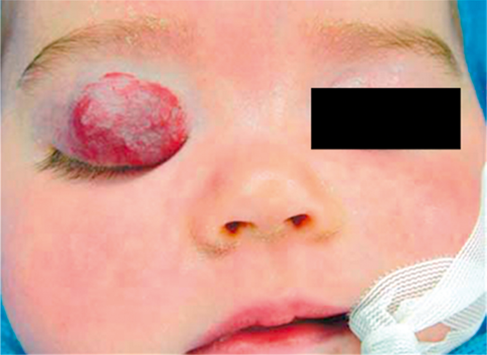 A clinical photograph shows the face of an infant with a prominent vascular lesion occupying the left upper eyelid. The lesion is round, raised, and red.