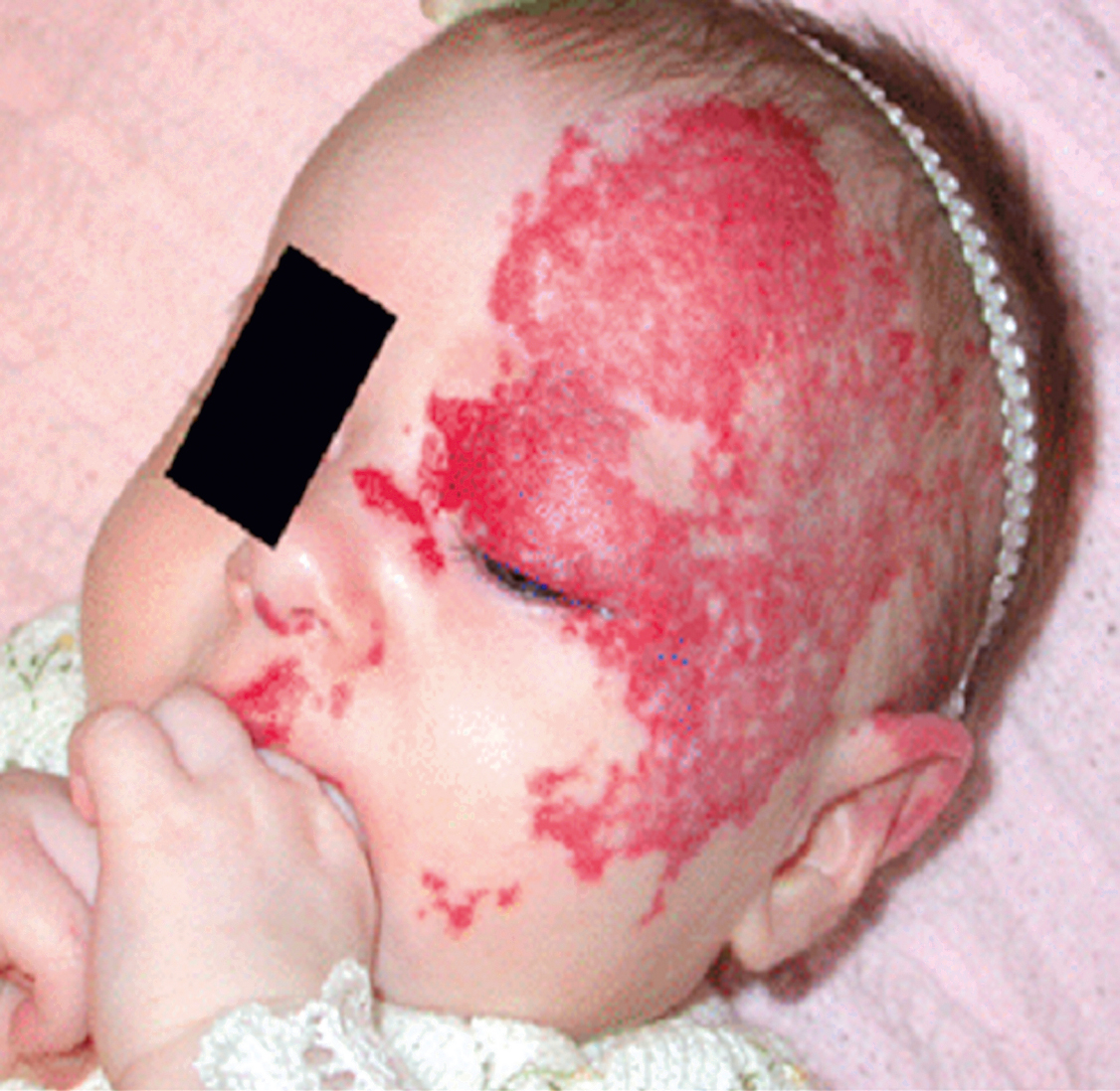 A clinical photograph shows an infant with a large red vascular lesion on the left side of the face, including scalp, upper eyelid, and cheek. The lesion has an irregular border and appears flat.