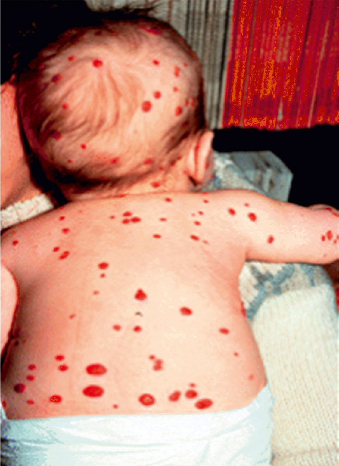 A clinical photograph of an infant’s back and scalp shows multiple well-defined, red, round vascular lesions, which appear dome-shaped and are sprinkled across the back.