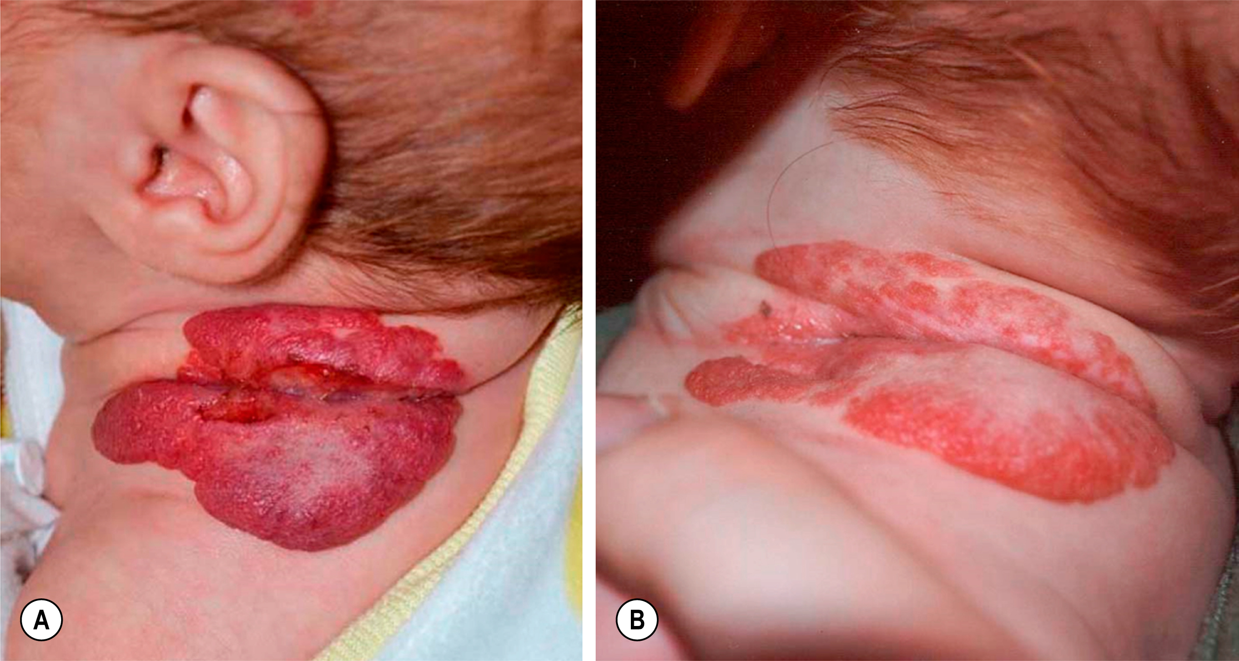 A two-part clinical photograph shows an infant with a large red vascular lesion on the left neck and upper shoulder. The two-part clinical photograph, labeled A and B, shows the left lateral neck of an infant with a segmental cutaneous hemangioma in two stages. Panel A shows the lesion during the proliferative phase, where it appears large, raised, and deep red with a lobulated surface. Panel B shows the same lesion in the involution phase, where the hemangioma has significantly faded, appearing flatter and lighter with residual skin wrinkling.