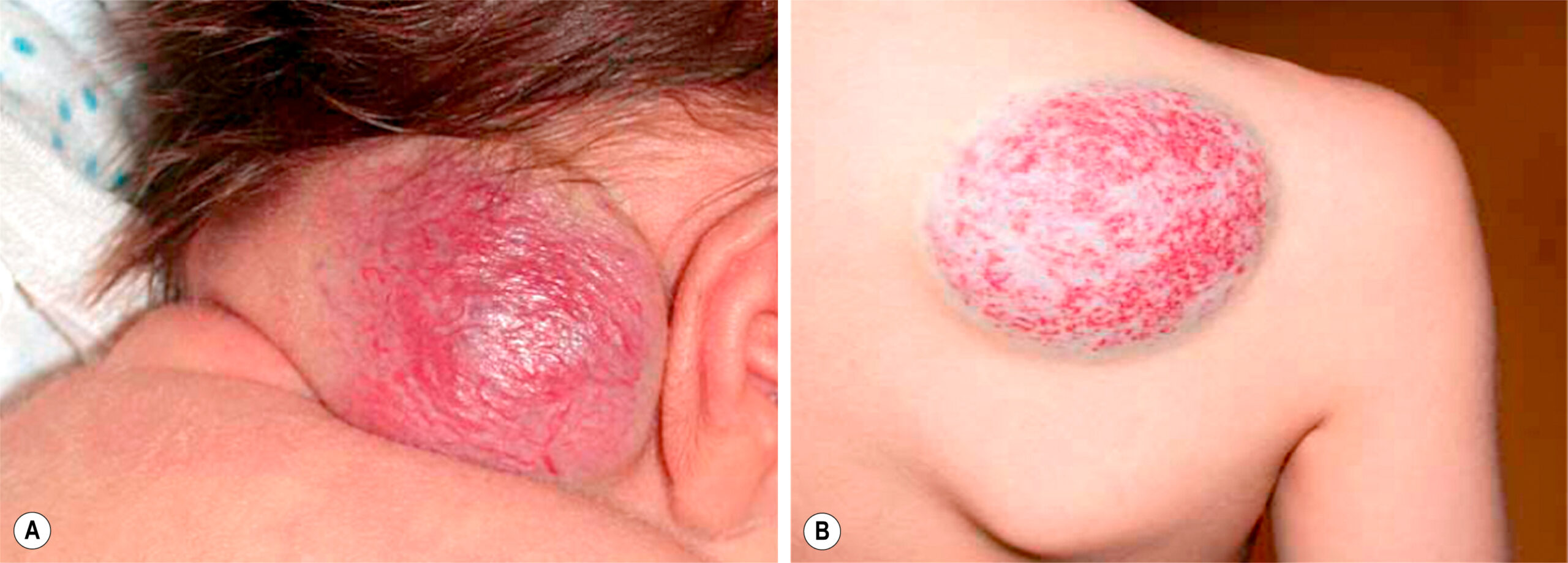 A two-part clinical photograph shows raised red vascular lesions on the neck and a shoulder. The two-part clinical photograph, labeled A and B, shows two patients with large, raised vascular lesions. Panel A shows a lobulated, shiny, swollen red lesion on the back of an infant’s neck near the hairline and ear. The surface appears taut and vascular. Panel B shows a well-circumscribed, dome-shaped lesion on a child’s right shoulder, with a red center and a pale peripheral halo.