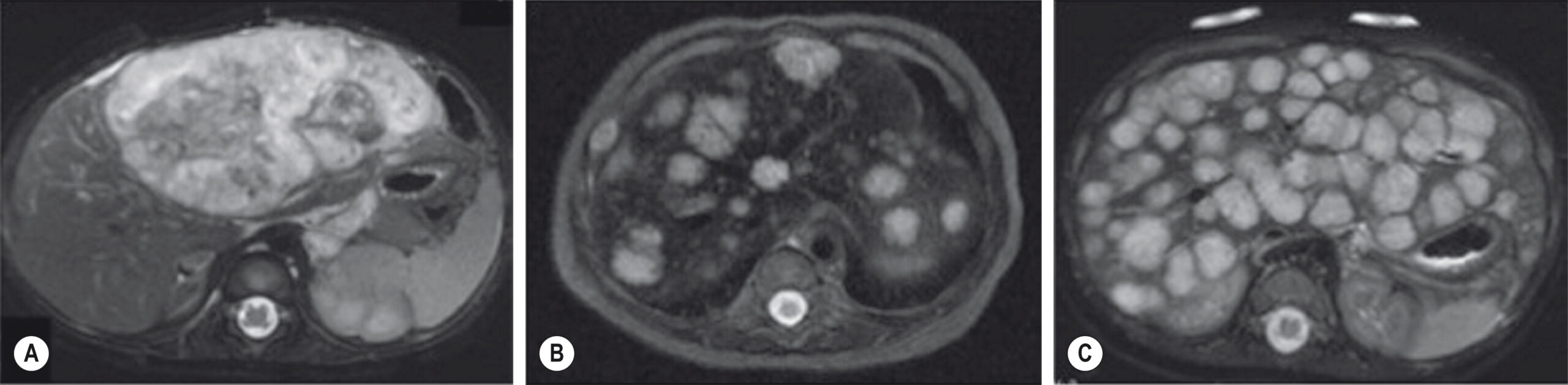 A set of three abdominal magnetic resonance imaging scans showing progressive multicystic transformation of the liver. The set of three abdominal magnetic resonance imaging scans, labeled A through C, demonstrates progressive stages of multicystic liver involvement. Panel A reveals a heterogeneous liver with irregular cystic and solid regions occupying the upper abdomen. Panel B shows an increased number of discrete, round cysts distributed throughout the hepatic parenchyma. Panel C exhibits nearly complete replacement of liver tissue by uniformly sized cysts, giving a spongy appearance.