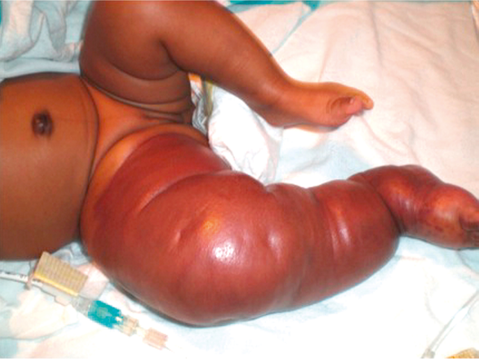A clinical photograph shows an infant with severe swelling and discoloration of the right leg. The clinical photograph shows the lower half of an infant lying on a hospital bed with marked swelling and shiny reddish discoloration of the entire right leg, extending from the thigh to the foot. The leg appears tense and enlarged.