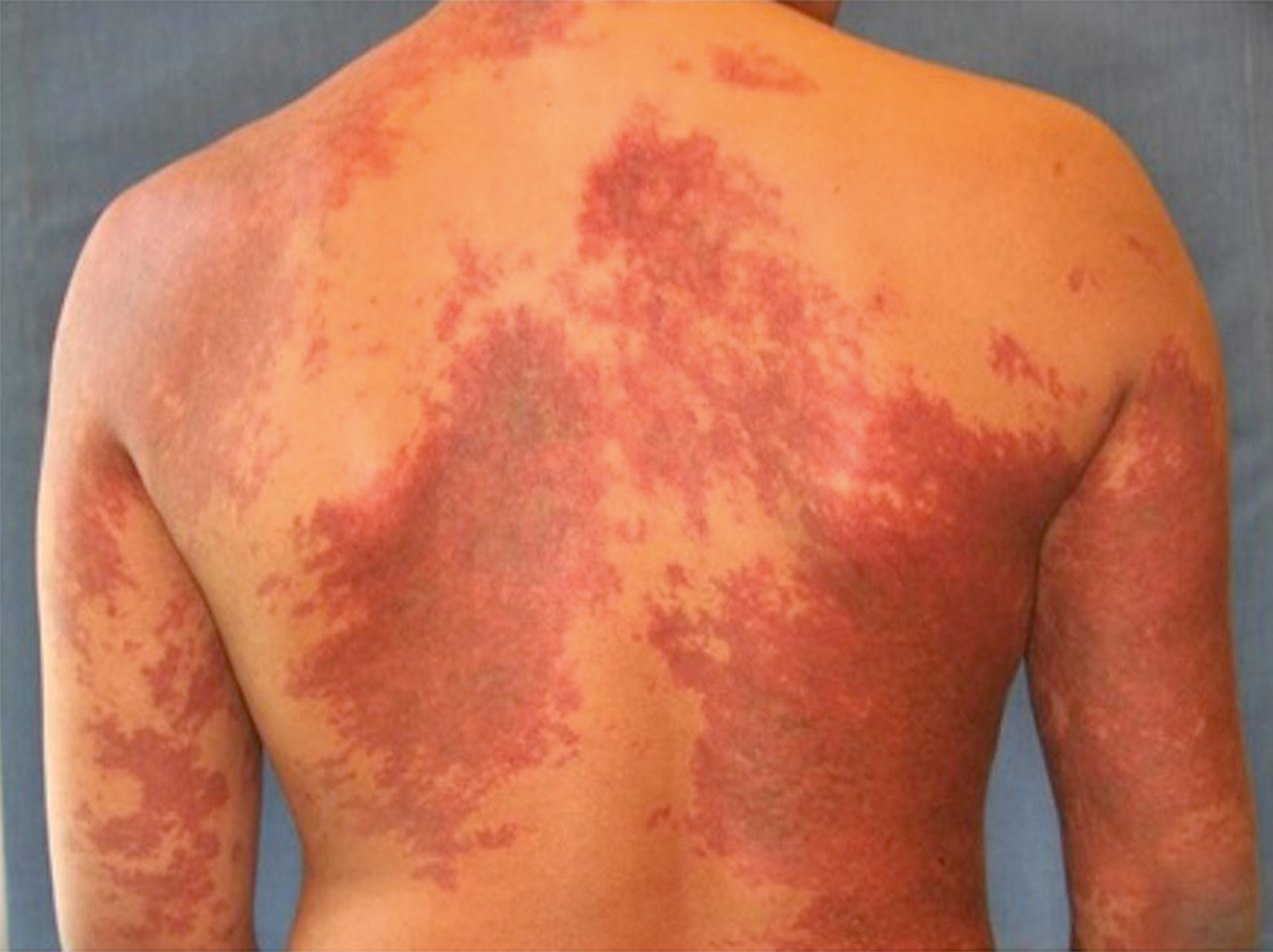 A clinical photograph showing widespread dark, irregular red vascular patches over the back and arms of a person. The lesions have a mottled appearance with uneven borders.