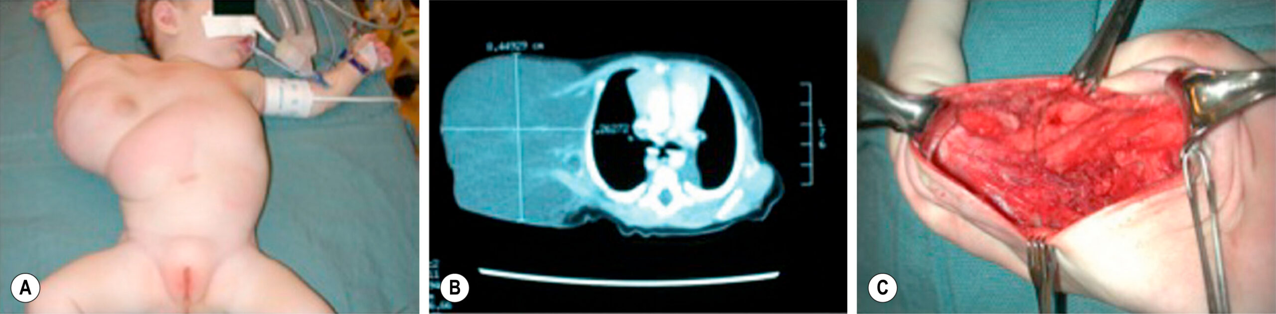 A three-part illustration shows a clinical photo, computed tomographic scan, and surgical view showing a large chest wall mass in an infant. The three-part illustration, labeled A, B, and C, shows the evaluation and surgical management of a large chest wall mass in an infant. Panel A shows a supine infant with a prominent, asymmetrical bulging mass on the right chest wall, extending to the arm. Panel B displays a computed tomographic scan in axial view, revealing a large soft tissue mass within the right thoracic cavity, displacing nearby structures. Panel C shows an intraoperative view with retractors exposing the surgical site, where the mass has been dissected from surrounding tissue.