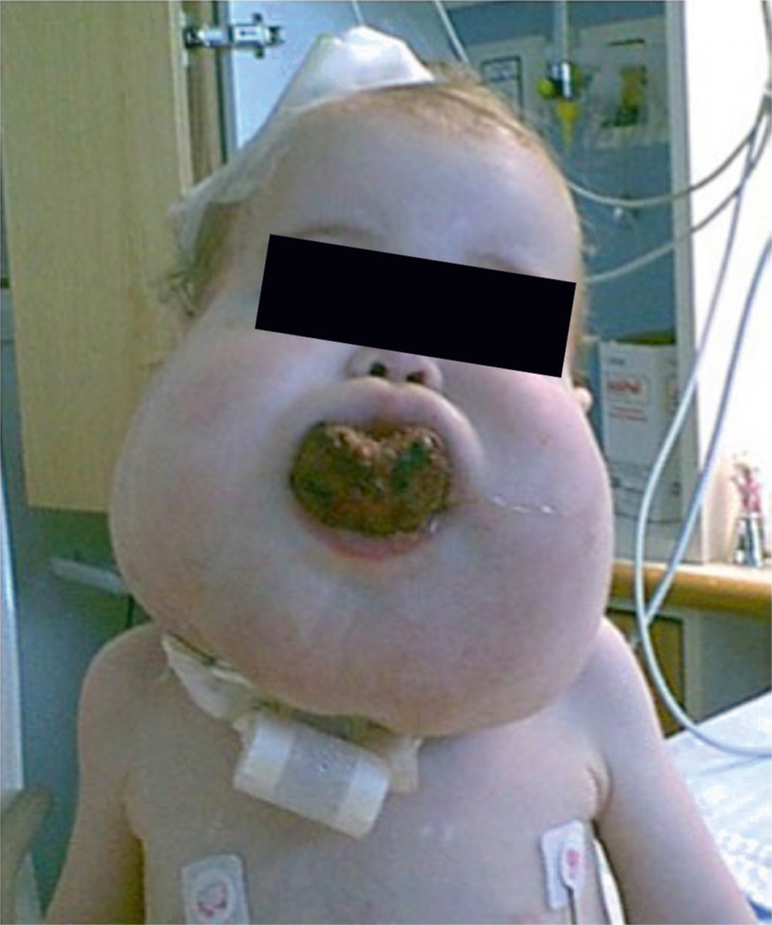 A clinical photograph shows a child with massive, bilateral facial swelling and a dark, ulcerated lesion protruding from the mouth. The lesion appears necrotic.