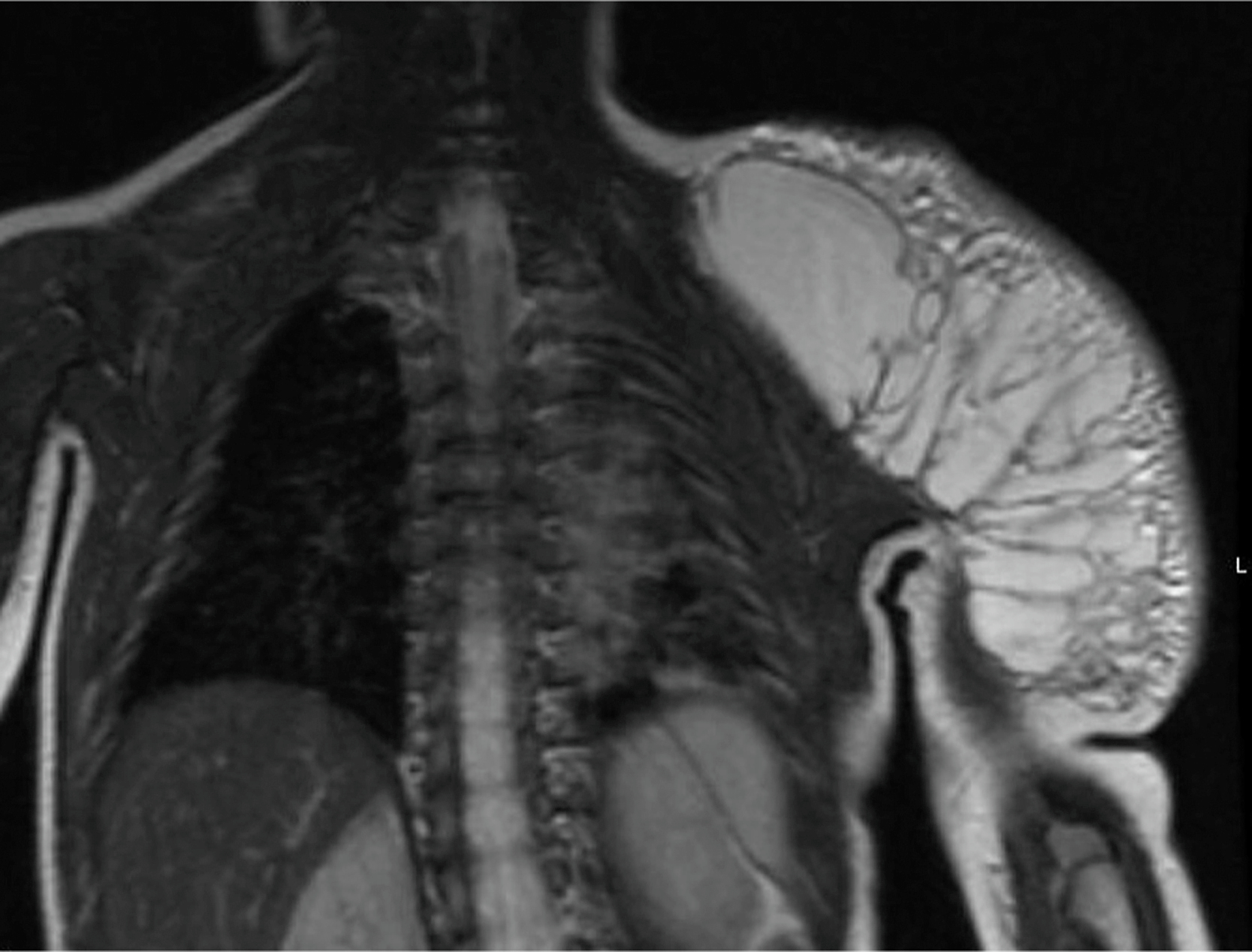 A magnetic resonance scan shows a large multiloculated lesion on the left shoulder extending from the upper back. The magnetic resonance scan shows a coronal view of the thorax and upper limbs, highlighting a large, multiloculated, fluid-filled lesion on the left shoulder. The lesion extends laterally and posteriorly from the scapular region and contains multiple internal septations with high signal intensity. The lesion causes distortion of normal soft tissue contours and appears well demarcated, without evidence of infiltration into the thoracic cavity.