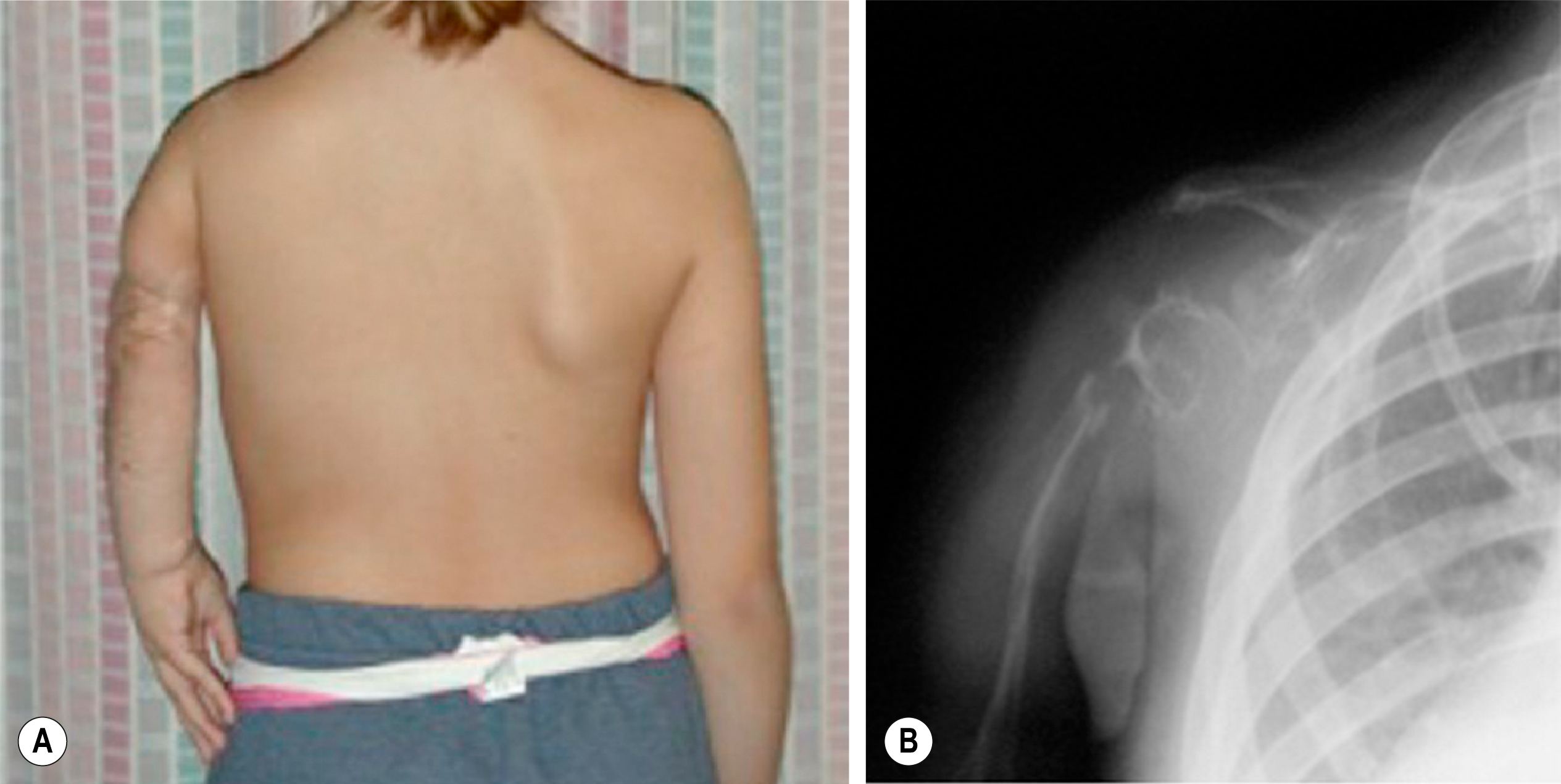A two-part illustration shows a clinical photograph and a radiographic image showing left arm overgrowth and soft tissue mass near the shoulder. The two-part illustration, labeled A and B, shows clinical and radiographic images of a case of upper limb overgrowth. Panel A shows the posterior view of a child with significant enlargement and elongation of the left upper extremity, including the arm and forearm, compared to the right side. The left arm appears bulky with abnormal contours, and the shoulder is elevated, making the arm shorter. Panel B shows a radiographic image of the left shoulder in lateral view, revealing a large soft tissue mass overlying the shoulder region, with preserved bony anatomy.