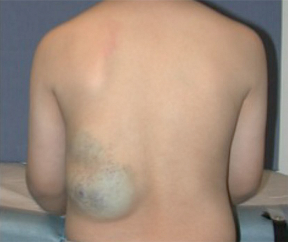 A clinical photograph of a child with a large, rounded, bluish swelling on the lower left back.
