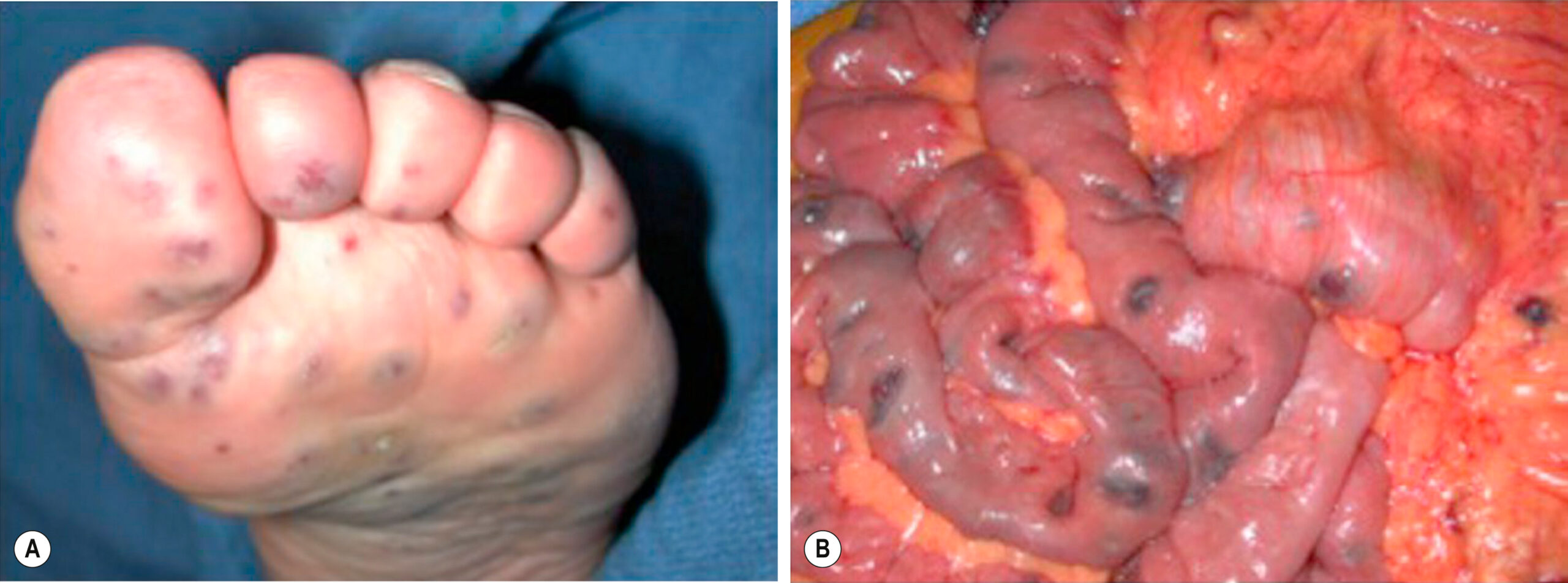 A two-part clinical image shows dark lesions on the sole of a foot in panel A and similar lesions on intestinal loops in panel B. The two-part clinical image, labeled A and B, demonstrates cutaneous and internal manifestations of a vascular malformation. Panel A displays the plantar surface of a foot with multiple dark, raised vascular lesions beneath the skins. Panel B shows an intraoperative view of the abdomen with small intestinal loops exhibiting similar dark vascular lesions on the serosal surfaces.