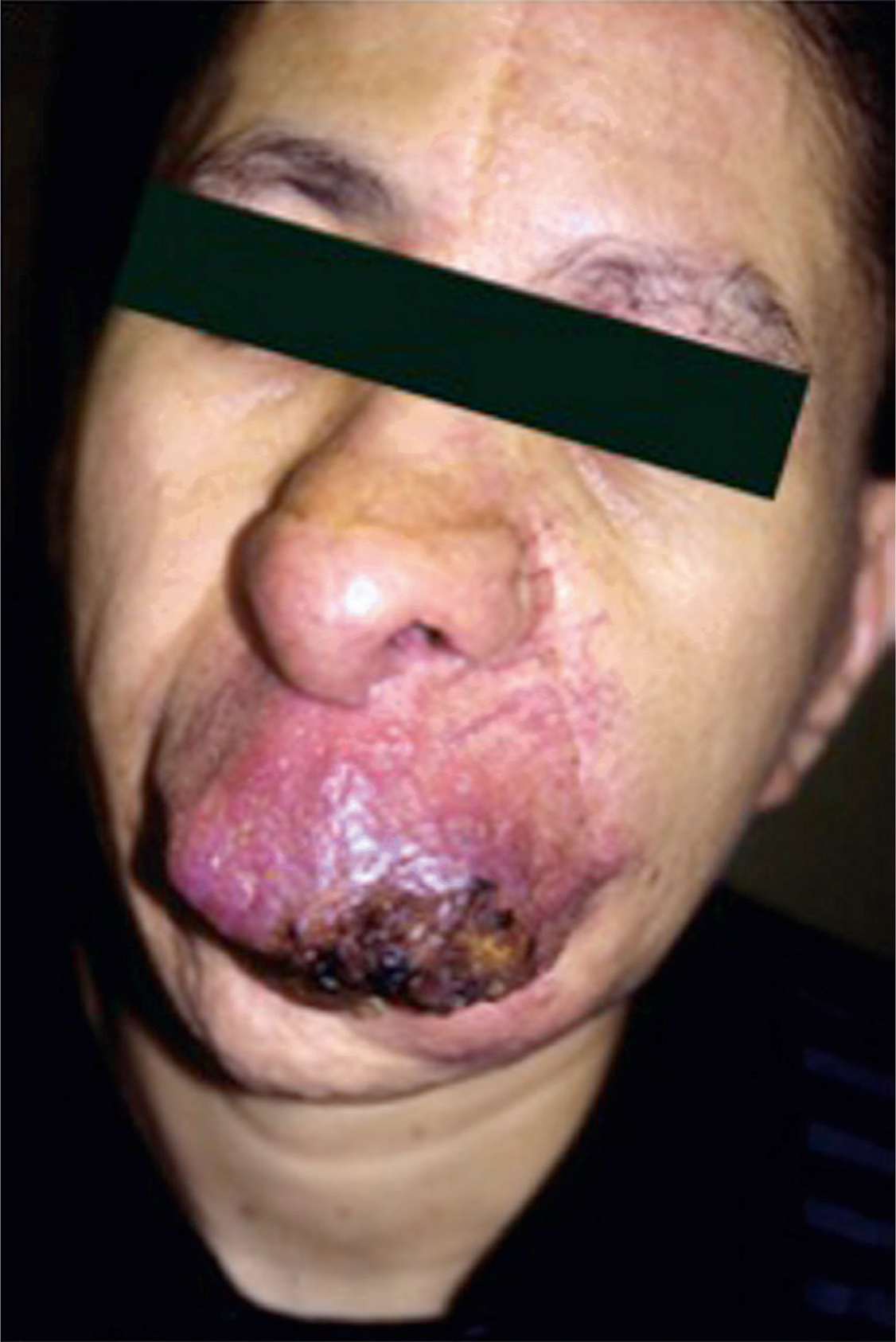 A clinical photograph shows an adult with a large, dark, lobulated swelling and ulceration on the lower face involving the lips. The lesion is partially ulcerated with areas of crusting and necrosis.