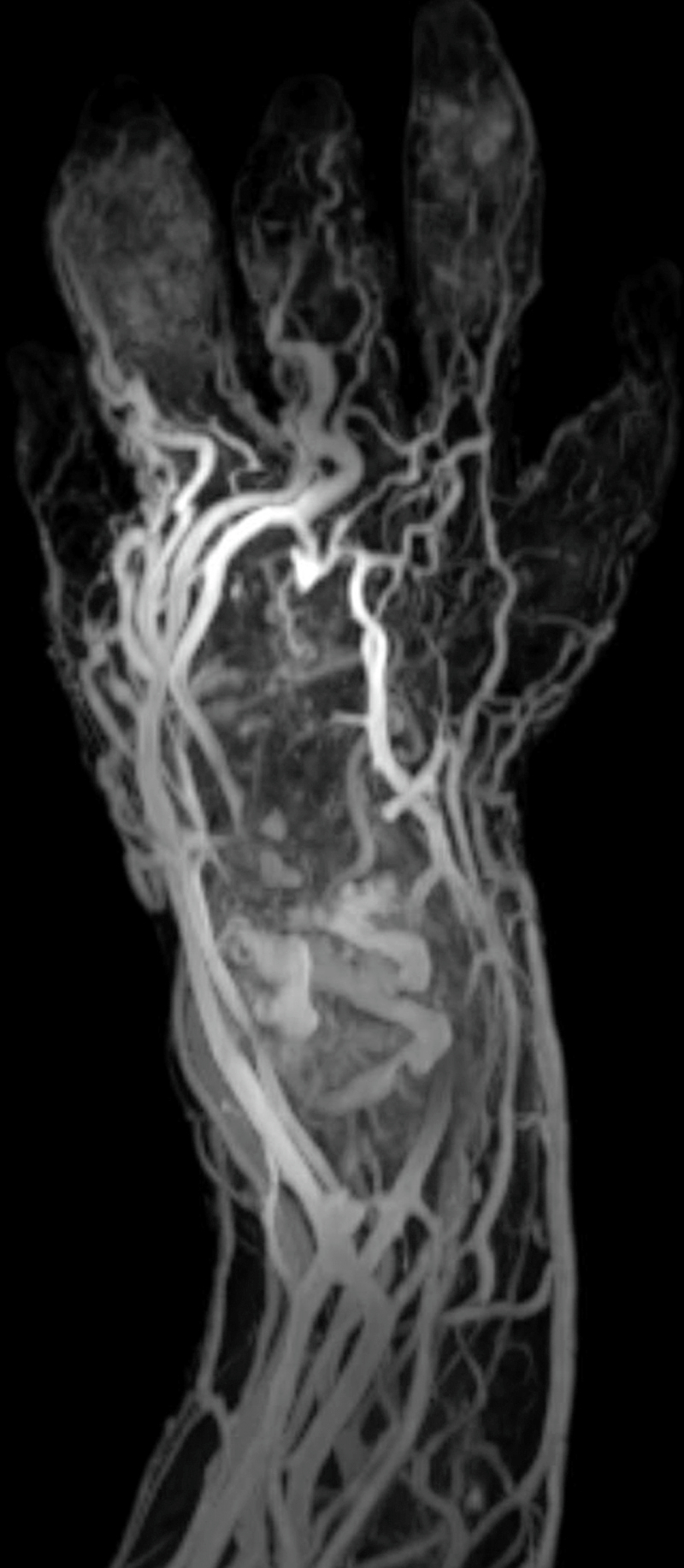 A magnetic resonance angiographic image showing abnormal vascular channels in the hand and forearm. The magnetic resonance angiographic image shows the vascular anatomy of a hand and forearm with numerous tortuous and dilated vessels. The image highlights abnormal, irregular vascular channels extending from the distal forearm into the palm and fingers. The enhanced contrast outlines both arteries and veins, revealing an extensive network of aberrant vasculature.