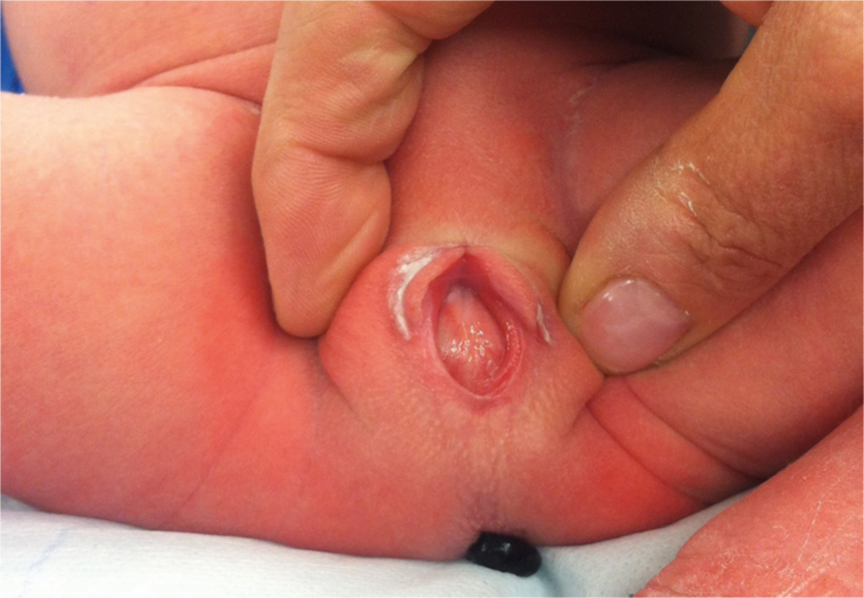 A clinical image shows the examiner's fingers holding the vaginal area of a newborn open to expose an accumulation of vaginal mucus at the opening.