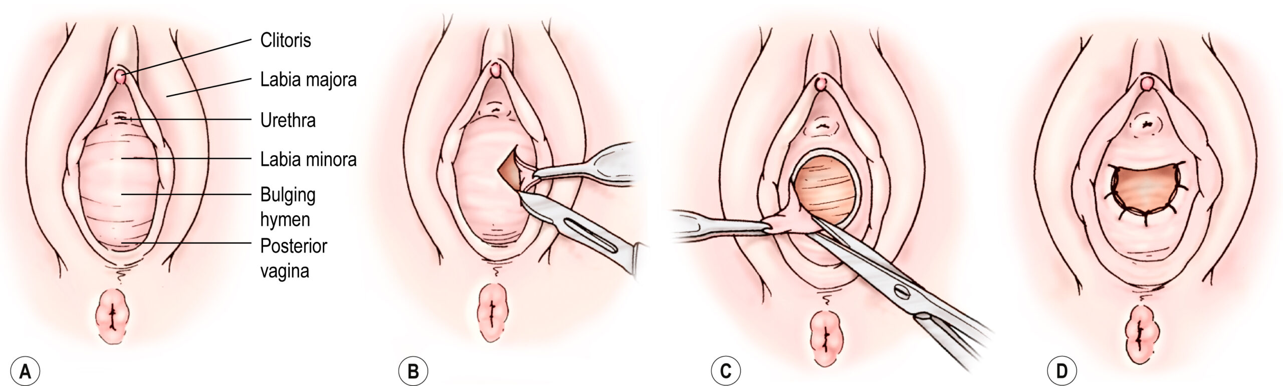 Four labeled illustrations show a bulging hymen and steps of hymenotomy, including incision and drainage of fluid from the vaginal canal. The four labeled illustrations, labeled A to D, show a stepwise depiction of hymenotomy for imperforate hymen. Panel A shows the external female genitalia with labeled structures: clitoris, labia majora, labia minora, urethra, bulging hymen, and posterior vagina. Panel B shows a pair of surgical scissors making an incision in the bulging hymen. Panel C illustrates the flaps of the incised hymen being trimmed. Panel D shows the vaginal opening post procedure with the hymenal edges sutured, creating a patent vaginal orifice.