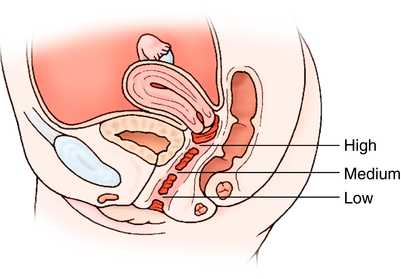 An illustration of the female pelvis showing high, medium, and low types of vaginal malformations. The illustration shows a sagittal section of the female pelvis identifying three levels of vaginal malformations based on the formation of septum in the vagina. The labeled levels are high, medium, and low. The high vaginal septum is present high up in the vaginal canal, near the cervix, with the medium and a low below, with the low vaginal septum present near the lower of the vaginal opening. The septum is shown obstructing the vaginal canal path.
