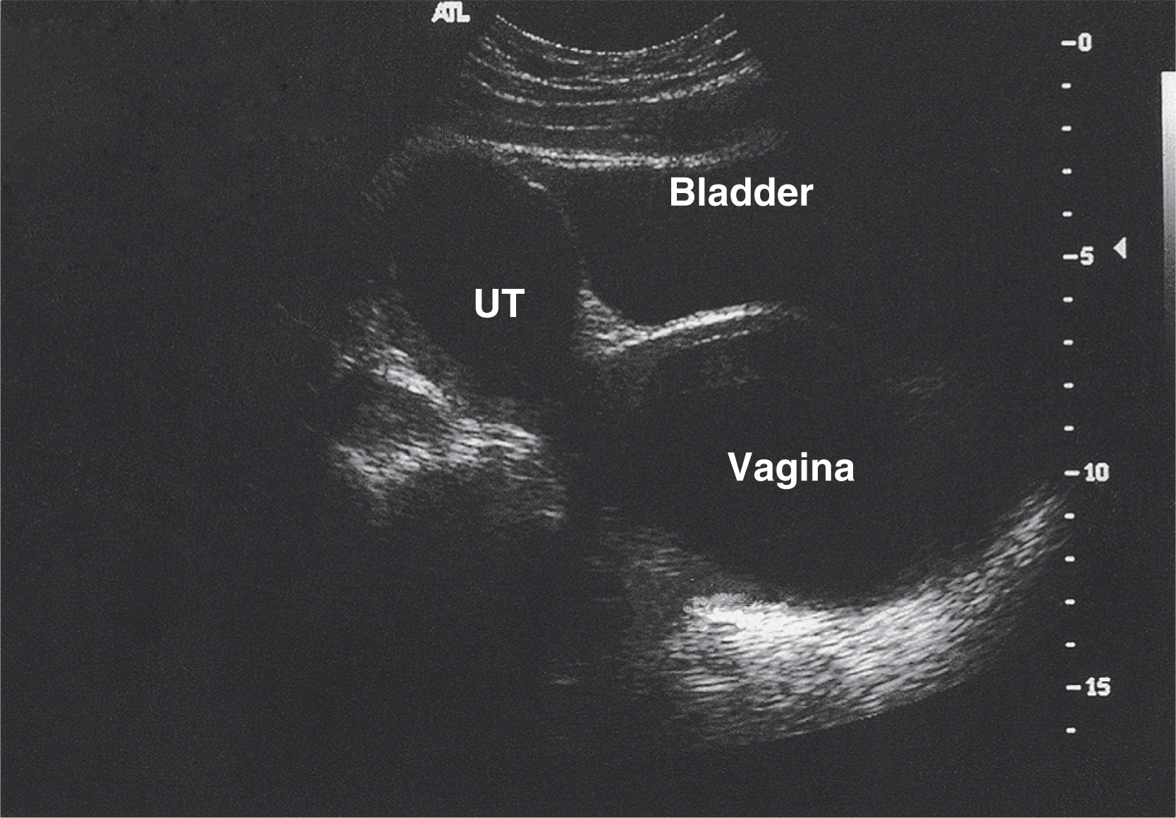 An ultrasound scan of the pelvis shows labeled bladder, uterus, and vagina. The ultrasound scan shows a transverse pelvic view with labeled anatomical structures including the bladder, uterus, and vagina. The bladder appears as a dark anechoic structure at the top, the uterus labeled as U T is centrally located, and the vagina is seen posterior to the bladder and uterus. Vertical measurement markings are present on the right side of the scan.