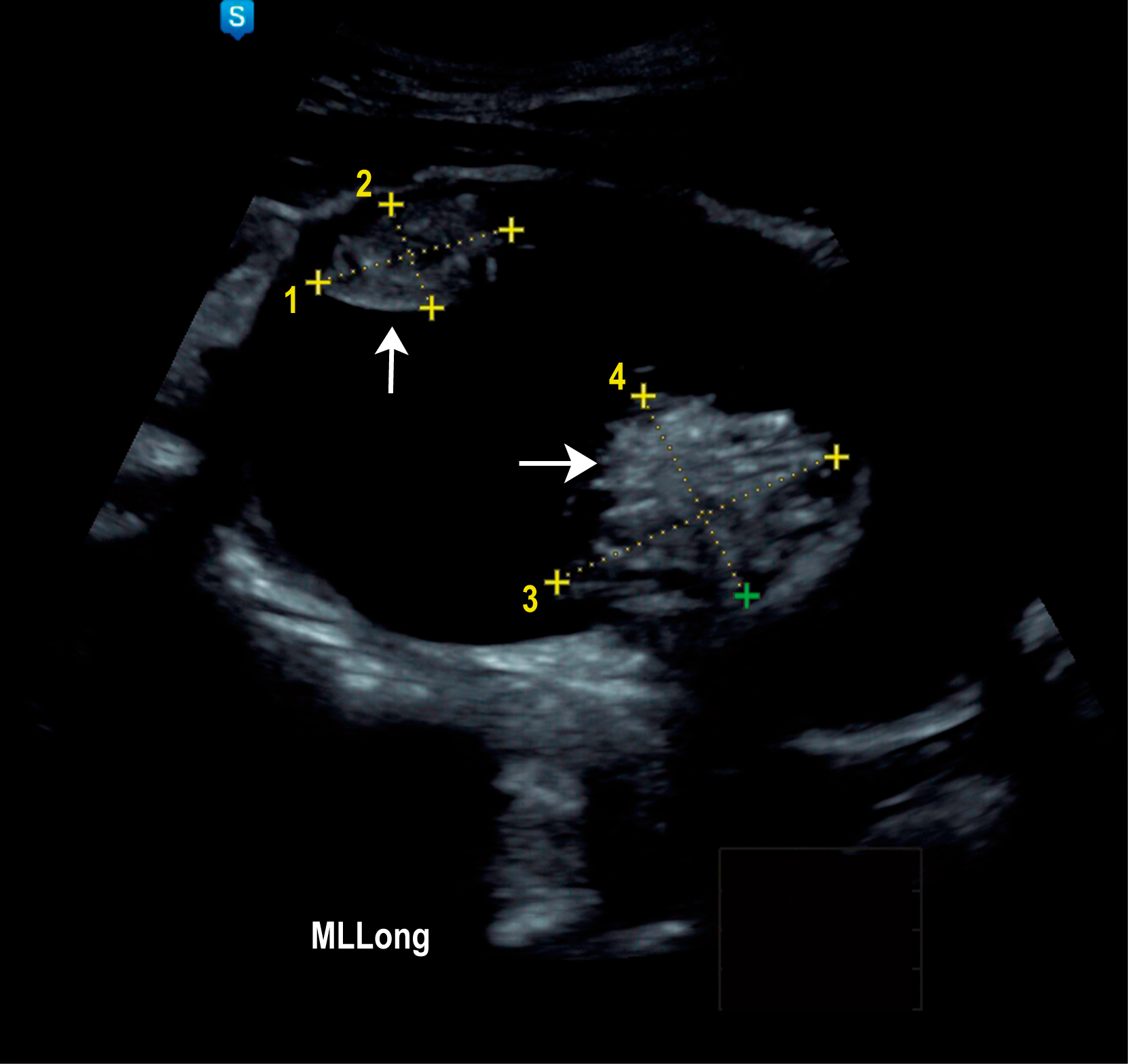 An ultrasound scan of an abdomen with labeled measurements and arrows indicating a benign teratoma. The ultrasound scan shows a longitudinal section of the uterus with two arrows pointing to anatomical structures of interest. The left arrow highlights a rounded tumor near the upper region, while the right arrow indicates a denser, more echogenic tumor near the center. The image includes numbered cross markers from one to four along the periphery of the highlighted areas. The label M L Long appears at the bottom.
