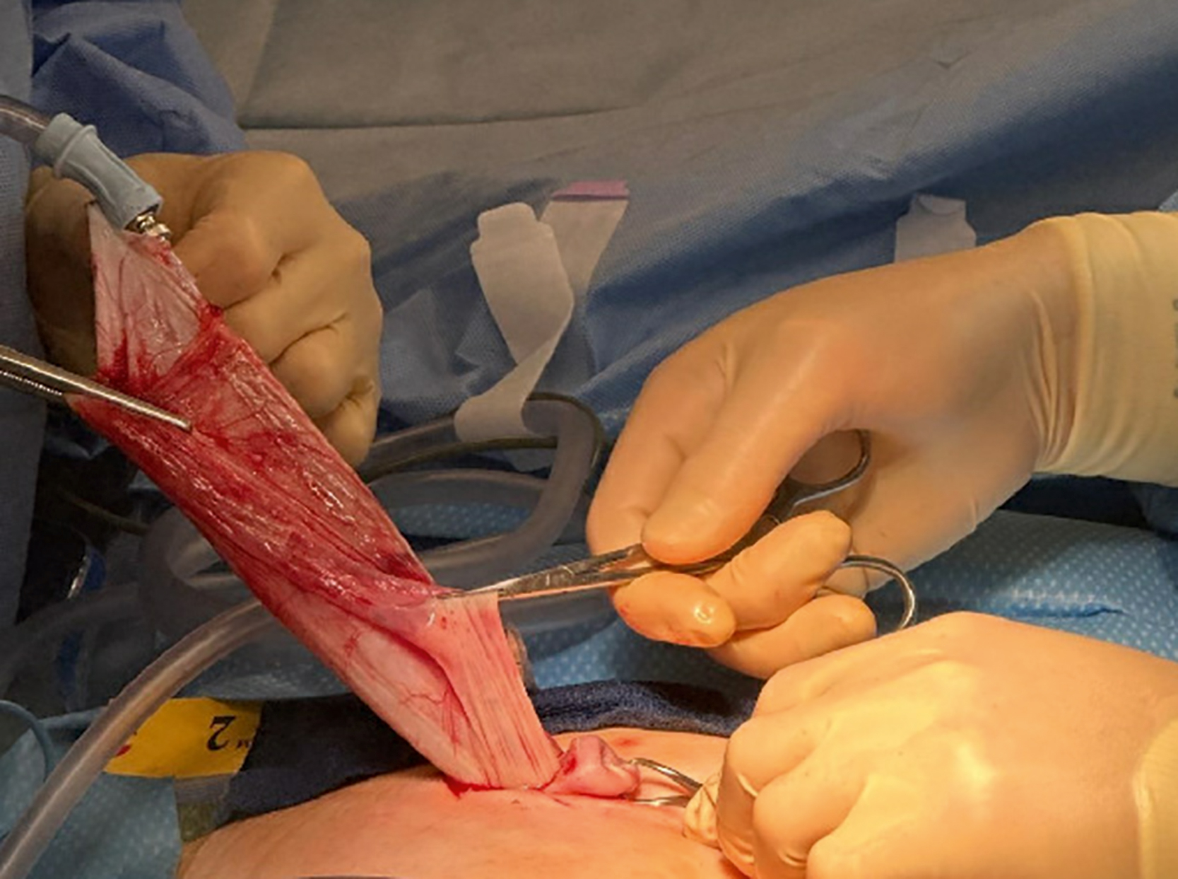 A surgical view shows gloved hands manipulating surgical instruments while extracting a long, blood-covered tissue strip from an incision on a patient's abdomen.