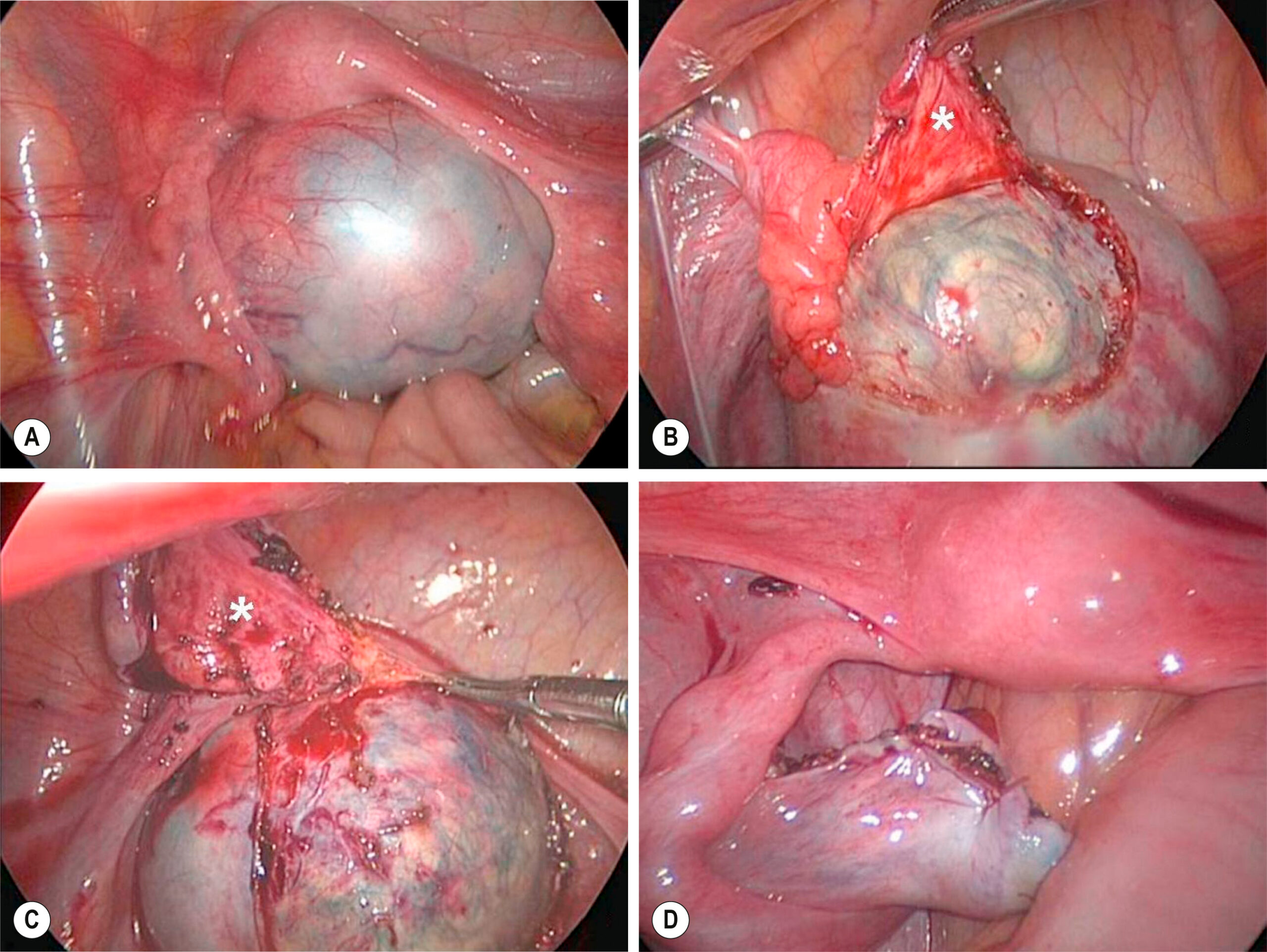 A four-part laparoscopic sequence shows the removal of a large ovarian cyst. The four-part laparoscopic sequence, labeled A to D, shows the surgical removal of a large ovarian cyst. Panel A shows a tense, translucent ovarian cyst within the pelvic cavity. Panel B shows surgical dissection of overlying tissue to expose the cyst, with fibrous and vascular structures marked by an asterisk. Panel C shows further dissection with clearer exposure of the cyst wall and vascular supply. Panel D shows the ovary following cyst removal, with visible tissue remodeling and absence of the previous mass.