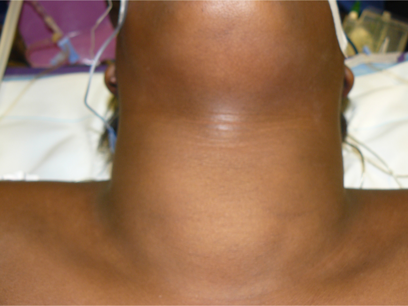 An anterior neck view shows a smooth, midline swelling extending from below the chin to the upper chest.