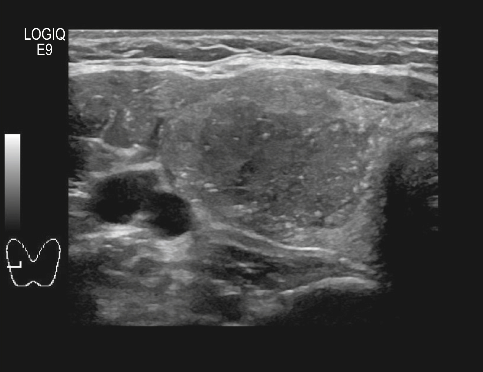 A longitudinal ultrasound scan shows a well-defined hypoechoic thyroid nodule with internal heterogeneity and mild posterior acoustic enhancement. The longitudinal ultrasound scan presents a thyroid region displaying a well-demarcated hypoechoic nodule situated within the thyroid parenchyma. The nodule demonstrates heterogeneous internal echotexture with scattered echogenic foci and no calcifications. Posterior acoustic enhancement is visible beneath the lesion. Surrounding thyroid tissue appears compressed but retains normal echogenicity.