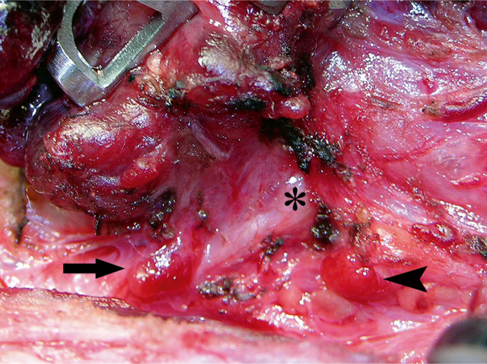 An intraoperative view shows the recurrent laryngeal nerve coursing through the tracheoesophageal groove marked by an asterisk, with surrounding vascular and soft tissue structures retracted. The intraoperative view shows the lower cervical region. The recurrent laryngeal nerve is centrally identified, running vertically within the tracheoesophageal groove and marked by an asterisk. Adjacent muscular and vascular structures have been retracted laterally to expose the nerve pathway. A broad arrow on the left points toward the trachea, and a narrow arrow on the right indicates the esophagus. The nerve appears intact and clearly separated from the surrounding tissue.