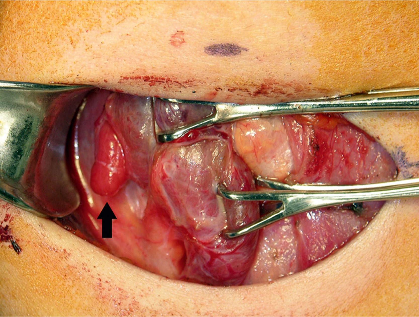 An intraoperative view shows a retracted neck incision exposing an enlarged right superior parathyroid adenoma, indicated by an arrow, positioned between adjacent vascular and muscular structures. The intraoperative surgical field displays a retracted neck incision revealing deep cervical anatomy. The central structure identified by an arrow is the enlarged right superior parathyroid adenoma, coursing vertically between the carotid artery and internal jugular vein. Multiple surgical retractors hold back overlying tissue layers, including muscle and fascia, to provide exposure. The parathyroid adenoma appears as a pale, cord like structure with longitudinal striations.