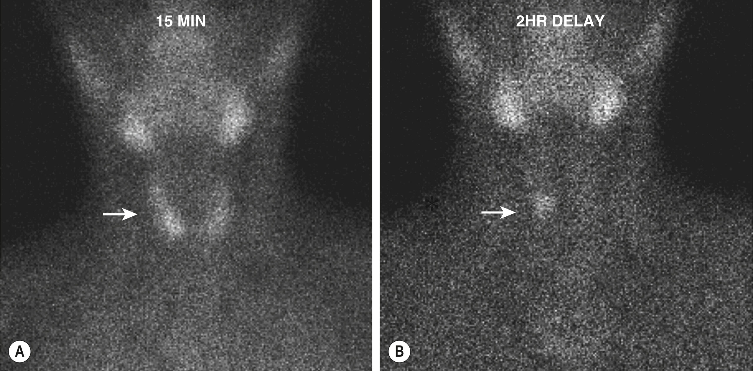 Two scintigraphy scans at fifteen minutes and two hours show focal radiotracer uptake in the midline neck, with delayed retention indicating potential parathyroid adenoma. The two scintigraphy panels labeled fifteen minutes and two hours delay display nuclear imaging of the anterior neck following radiotracer injection. Both views reveal symmetrical tracer distribution in the thyroid lobes with a focal area of increased uptake located inferior to the thyroid poles, indicated by arrows in both panels. The radiotracer retention persists in the delayed visual, suggesting delayed washout typical of parathyroid adenoma.