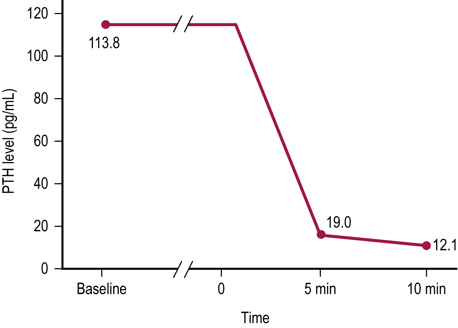 A line graph shows parathyroid hormone levels dropping from one hundred thirteen point eight to twelve point one picograms per milliliter over ten minutes after surgical excision. The line graph displays parathyroid hormone levels over time in picograms per milliliter, with values plotted at baseline, zero, five, and ten minutes. At baseline and zero minutes, the hormone level is one hundred thirteen point eight. At five minutes, it drops sharply to nineteen, and by ten minutes, it further decreases to twelve point one. The steep decline between zero and five minutes indicates a successful surgical response, consistent with intraoperative monitoring criteria for parathyroidectomy. The horizontal axis represents time, while the vertical axis is labeled parathyroid hormone level in picograms per milliliter. A break appears on both axes to emphasize the rapid change within a short interval.