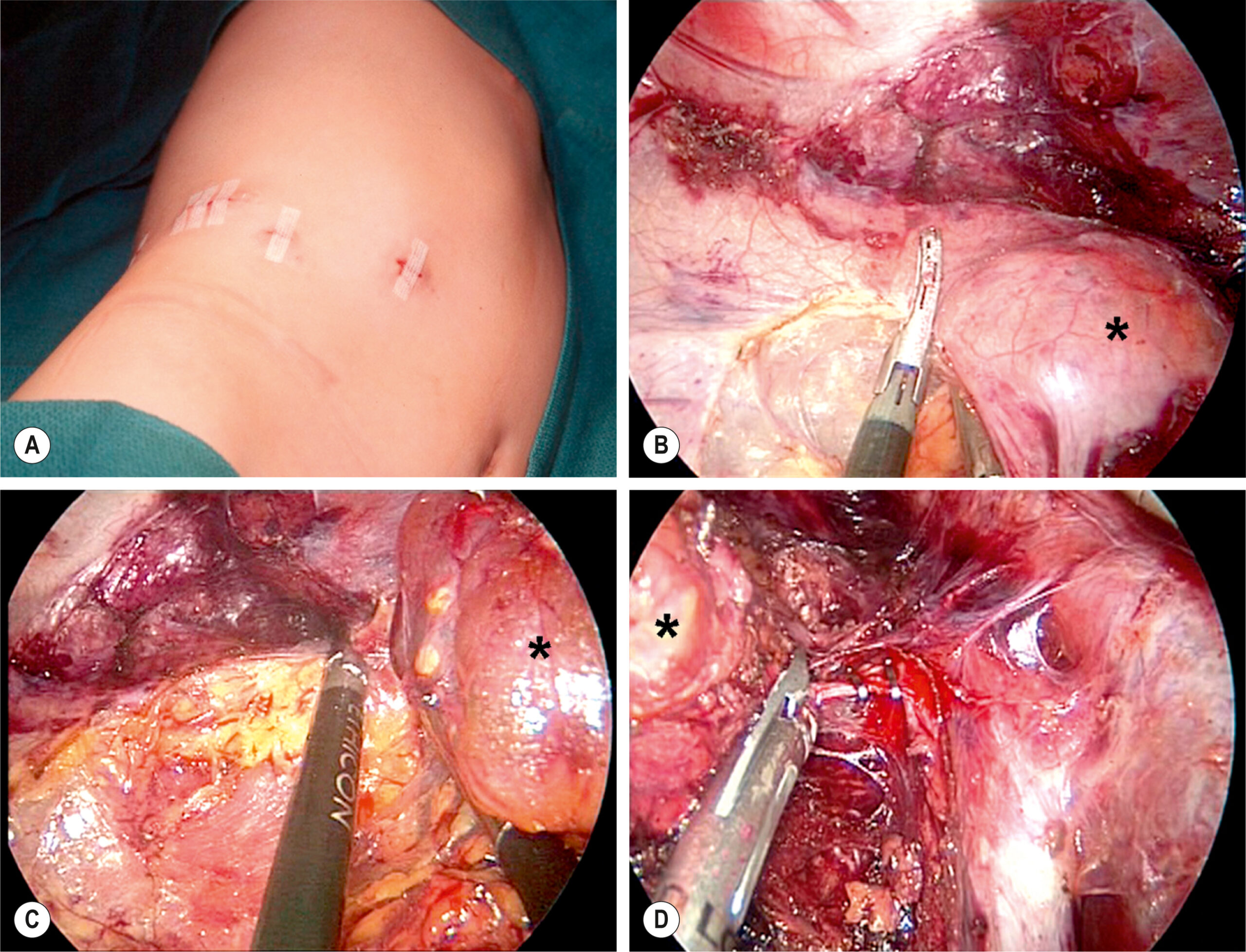 A four-panel surgical series shows port placement and laparoscopic adrenalectomy steps with dissection, mobilization, and removal of the adrenal tumor indicated by an asterisk in each view. The four-panel surgical sequence, labeled A to D, demonstrates the procedural steps of laparoscopic adrenalectomy. Panel A shows the lateral abdominal wall with three small skin incisions for port placement following insufflation. Panel B shows a laparoscopic view with surgical graspers dissecting tissue planes near a glandular mass, marked with an asterisk, surrounded by fatty and vascular structures. Panel C continues the dissection, showing the adrenal mass being separated from adjacent tissue using an energy device, again marked with an asterisk. Panel D shows final mobilization with exposed adrenal vessels and surrounding structures, highlighting completion of adrenal gland isolation.
