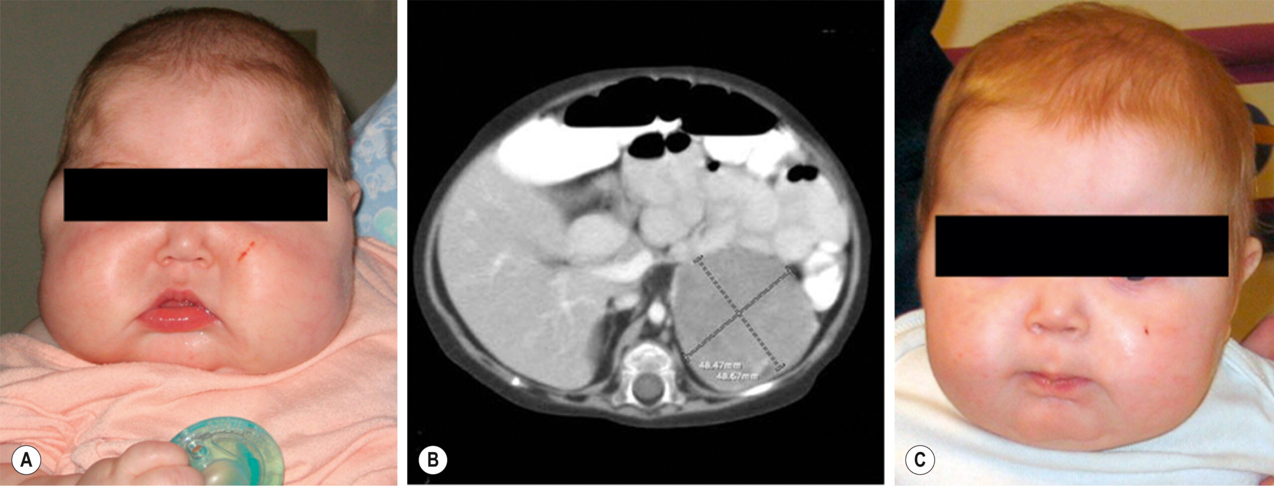 A three-panel sequence shows a child with facial swelling before surgery, a computed tomographic scan revealing an adrenal mass, and post-surgery facial improvement. The three-panel sequence, labeled A, B, and C, presents a clinical case of adrenal pathology in an infant. Panel A shows a frontal view of the child's face with pronounced swelling and fullness. Panel B displays an axial computed tomographic scan of the abdomen showing a large adrenal mass with heterogeneous density in the upper abdomen, adjacent to the kidney, displacing surrounding structures. Panel C shows the same child after surgical intervention, now with visibly reduced facial swelling and improved facial contour.